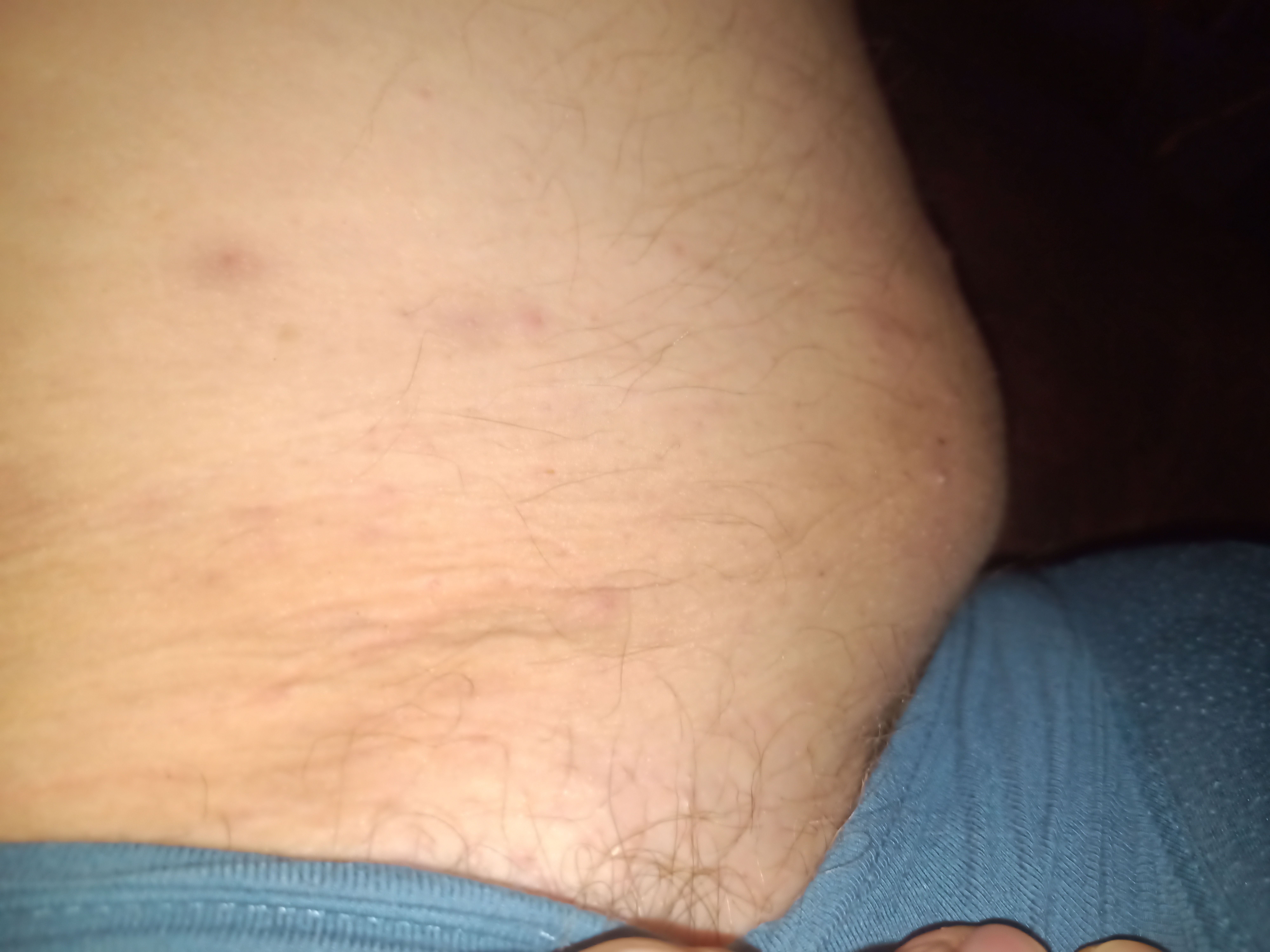 Oberschenkel Cellulite