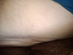 Cellulite