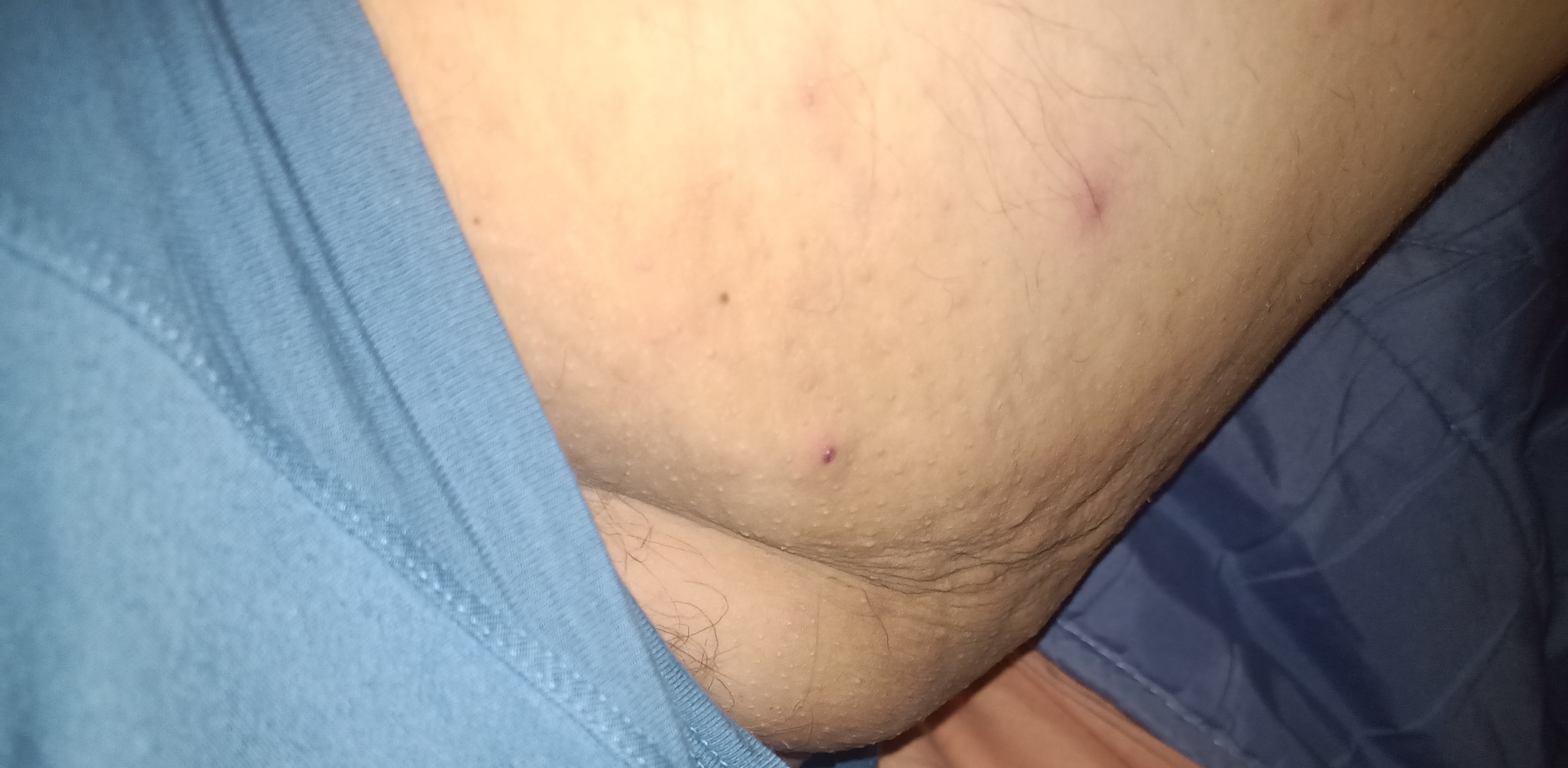 Oedem Cellulite