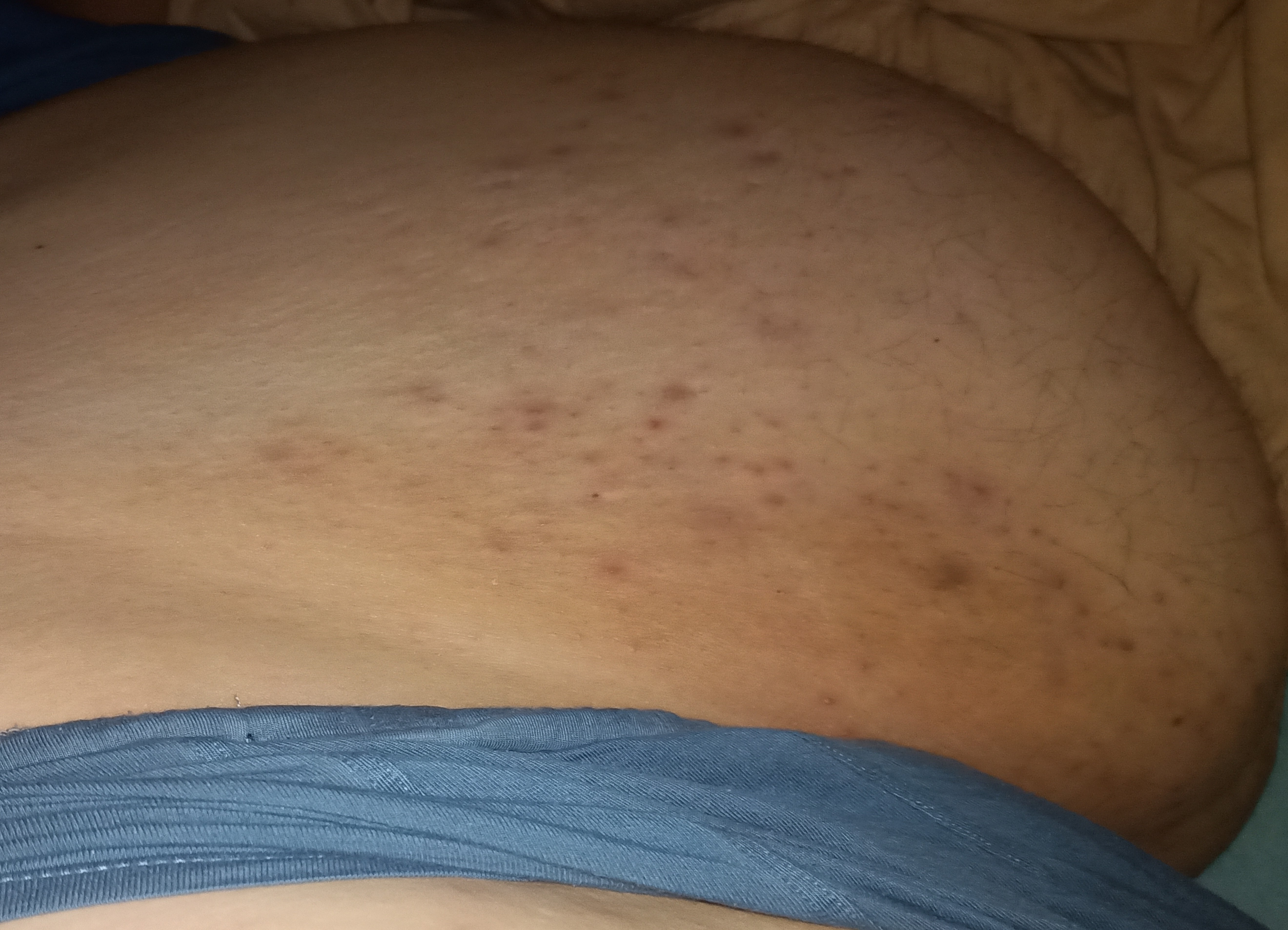 Exzem Bauch