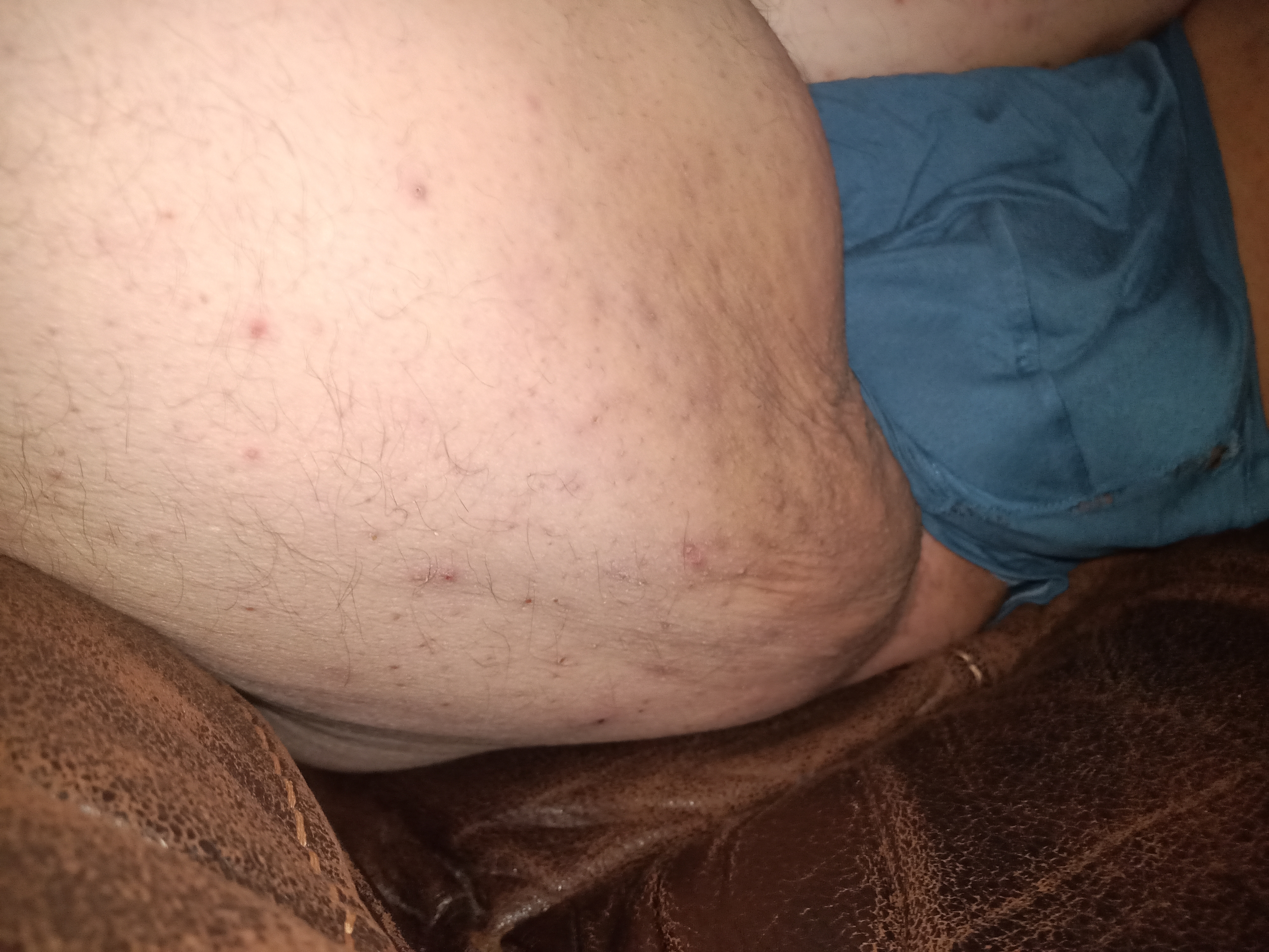 Oedem Cellulite