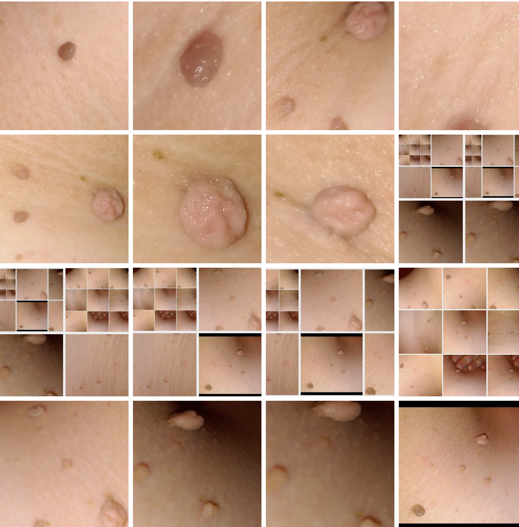 Fibrom, Stilwarzen am Halse