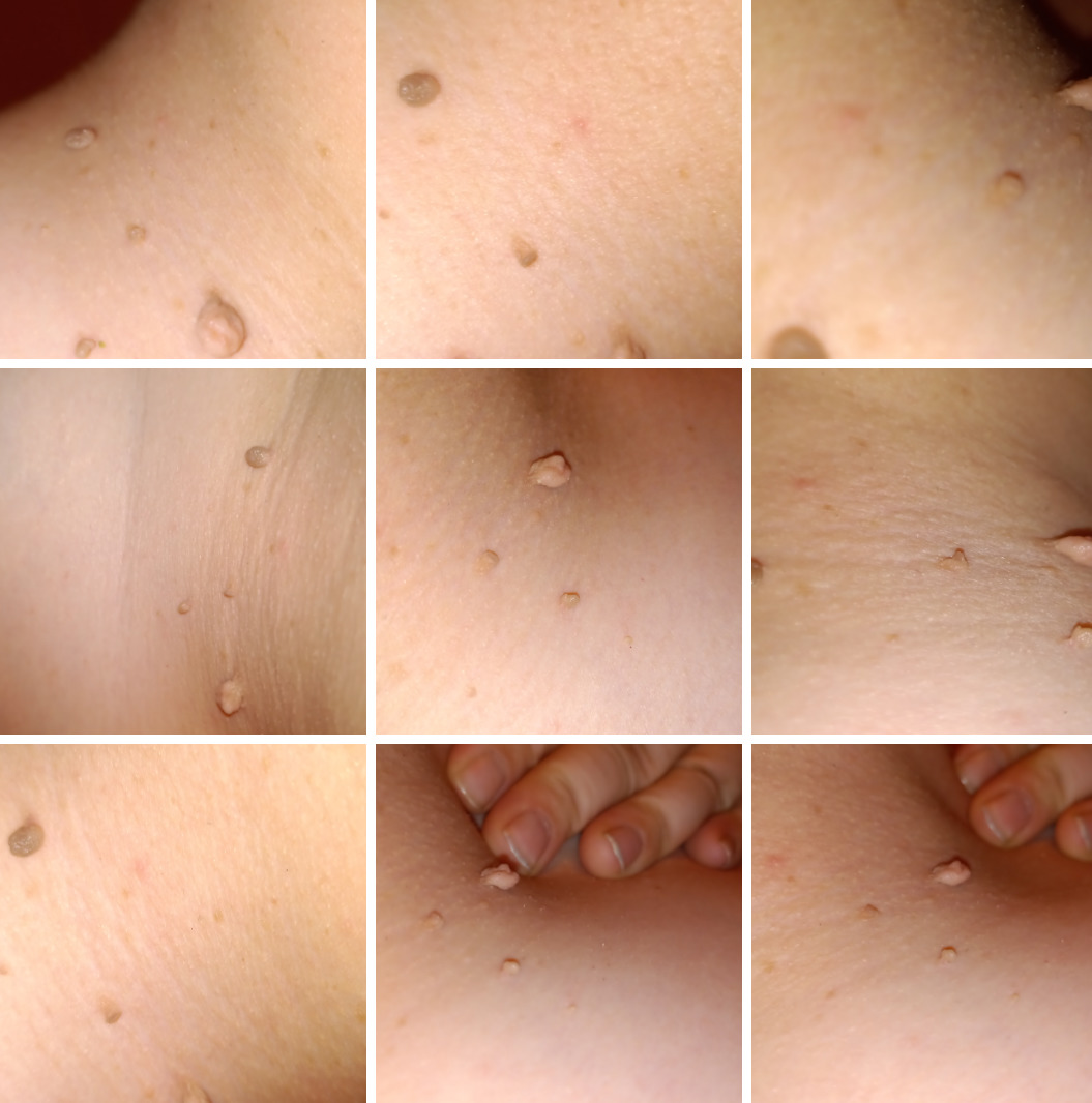 Fibrom, Stilwarzen am Halse