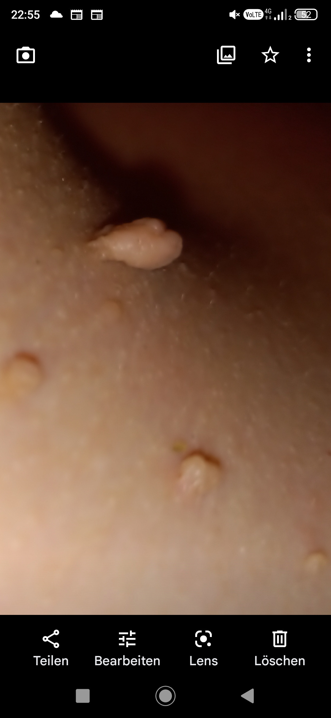 Fibrom, Stilwarzen am Halse
