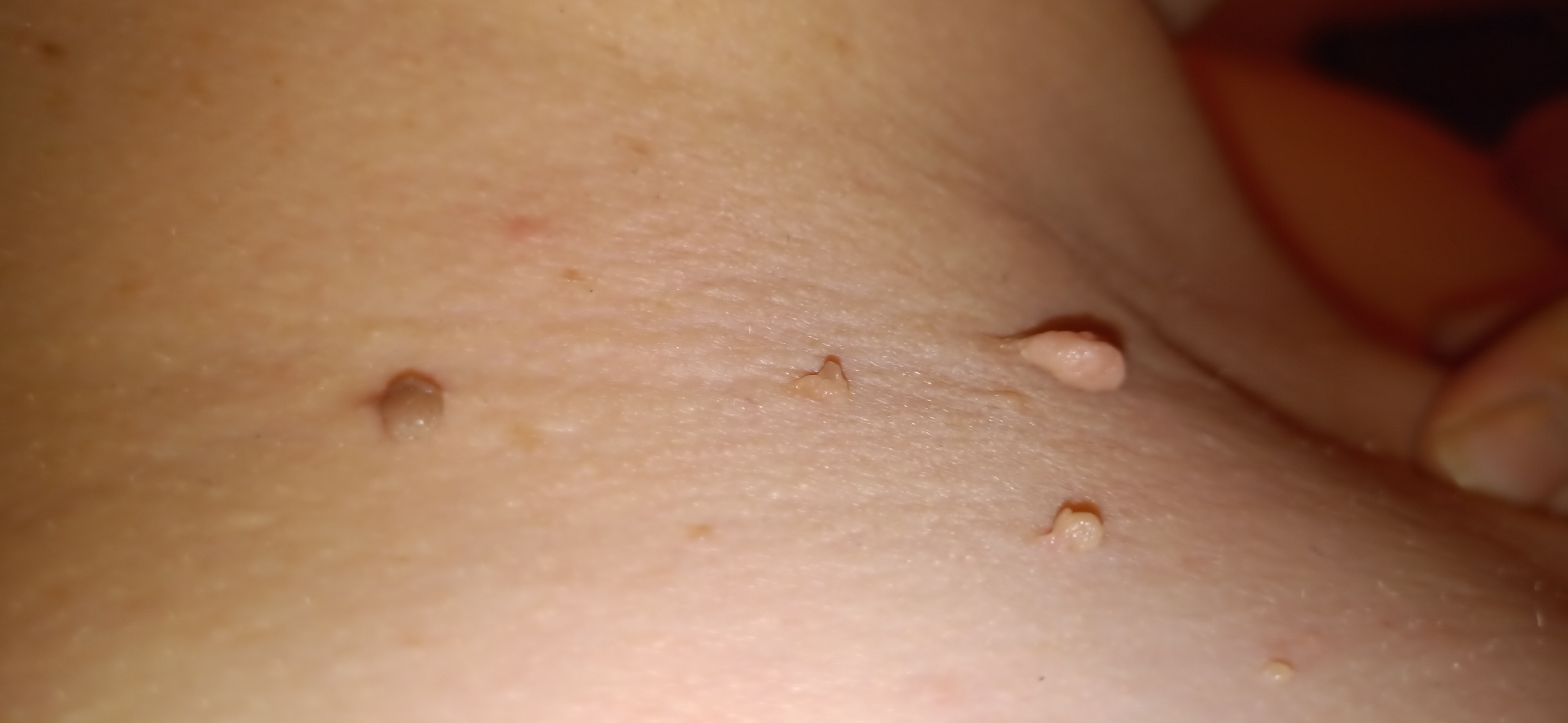Fibrom, Stilwarzen am Halse