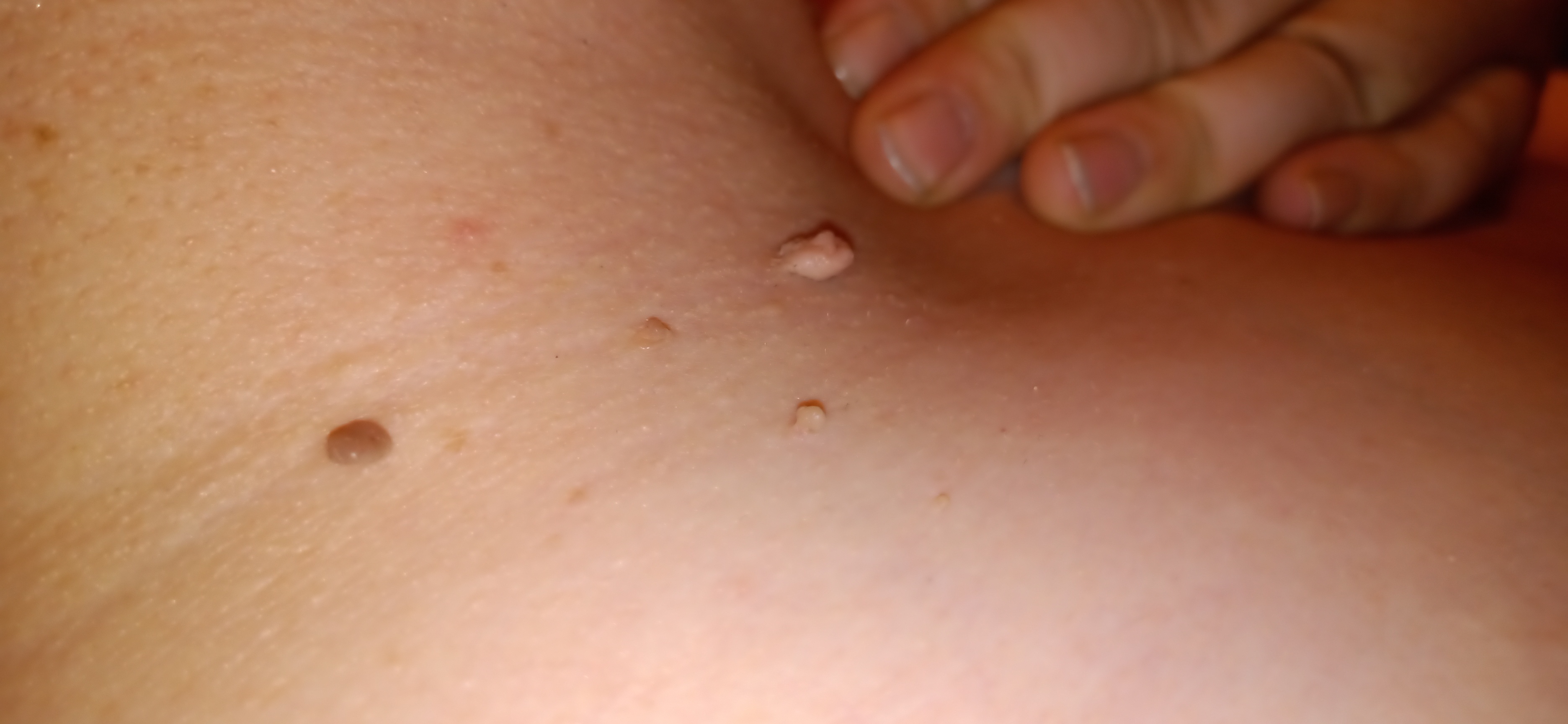 Fibrom, Stilwarzen am Halse