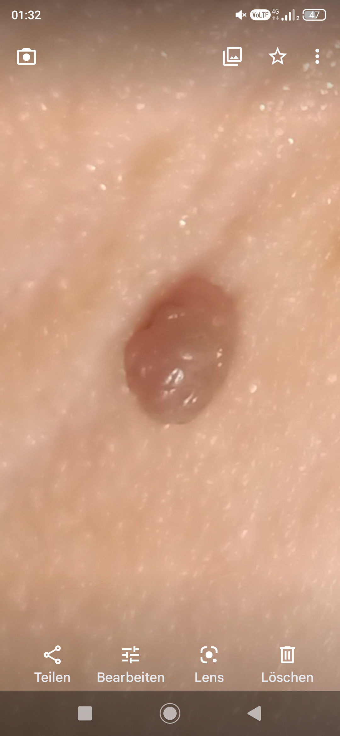 Fibrom, Stilwarzen am Halse