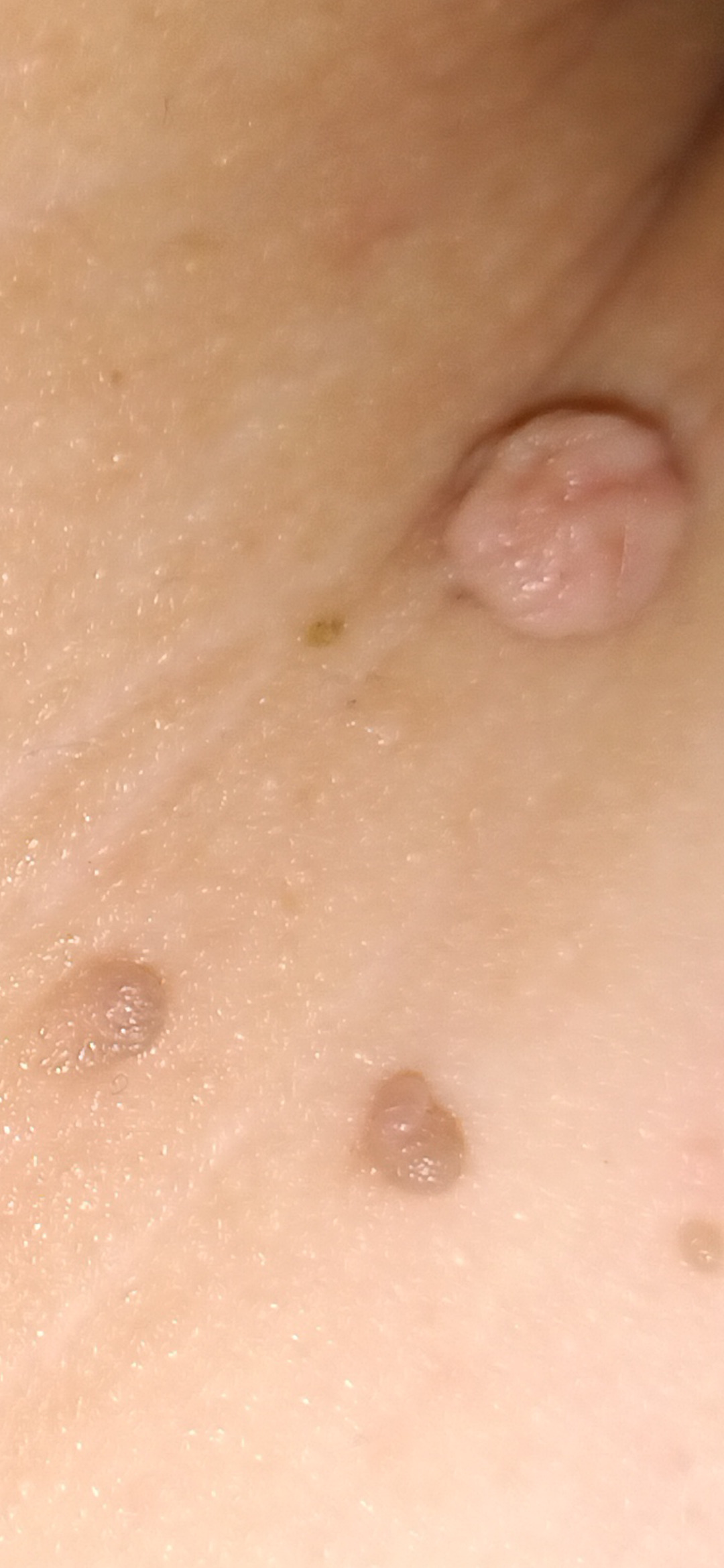 Fibrom, Stilwarzen am Halse
