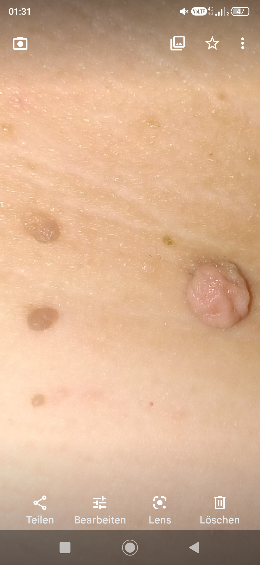 Fibrom, Stilwarzen am Halse