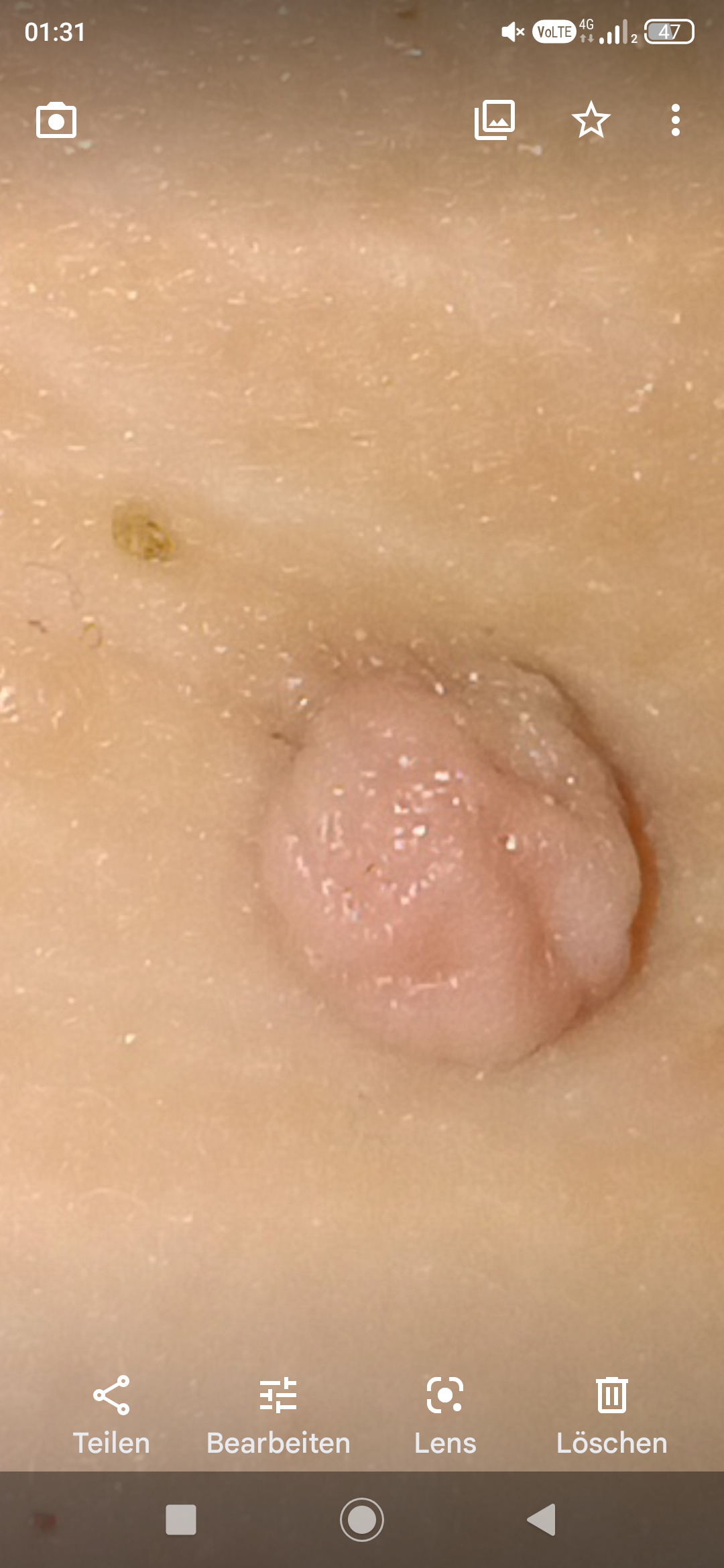 Fibrom, Stilwarzen am Halse