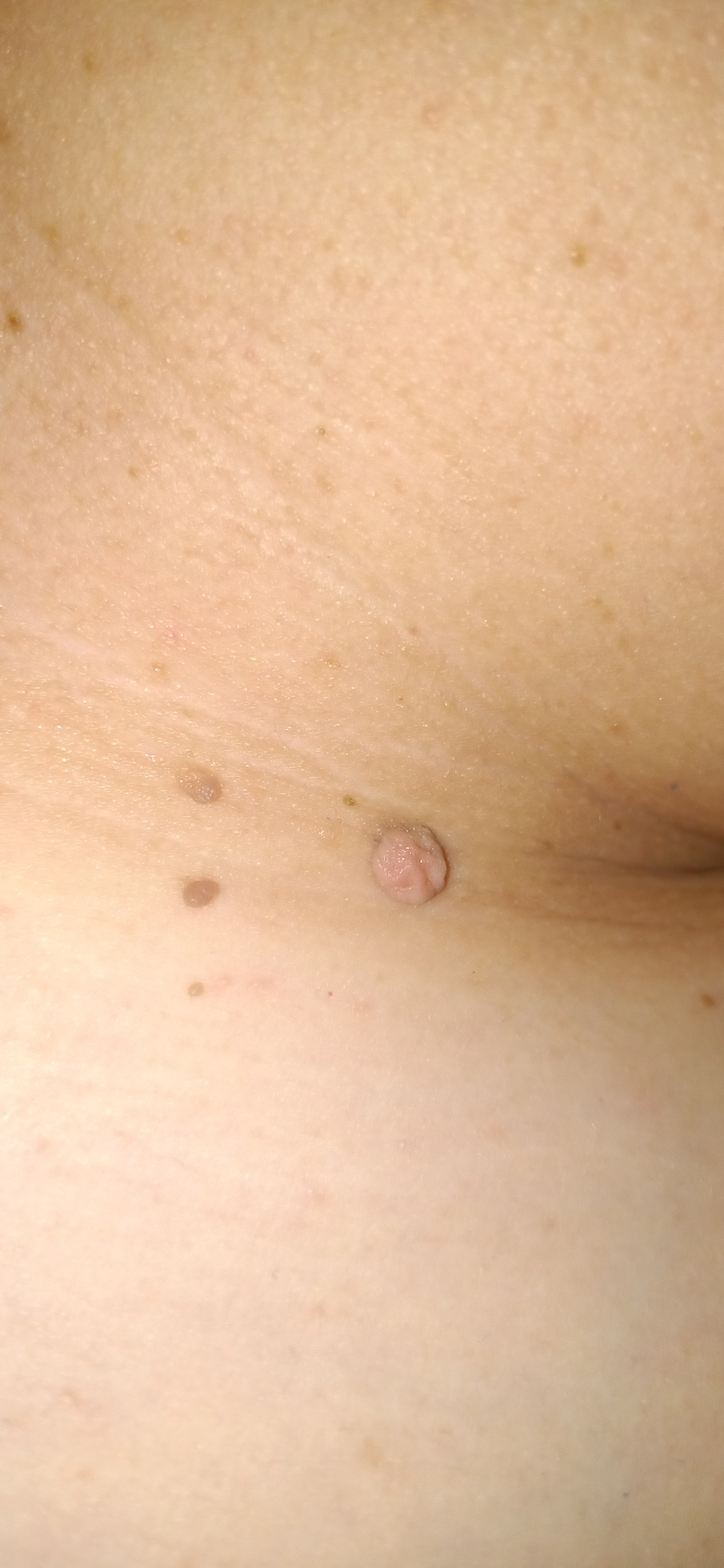 Fibrom, Stilwarzen am Halse