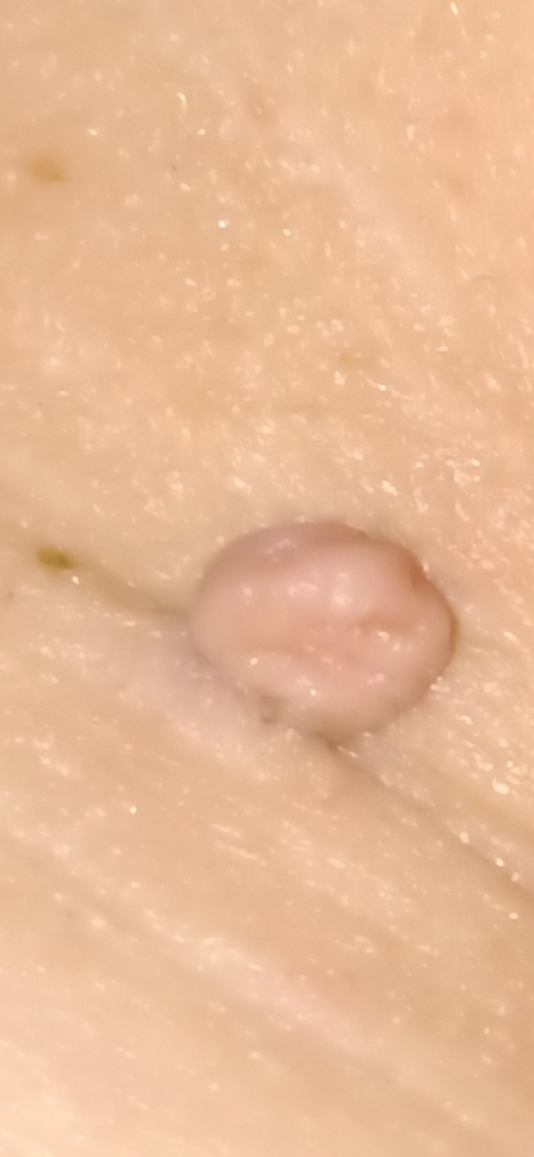 Fibrom, Stilwarzen am Halse