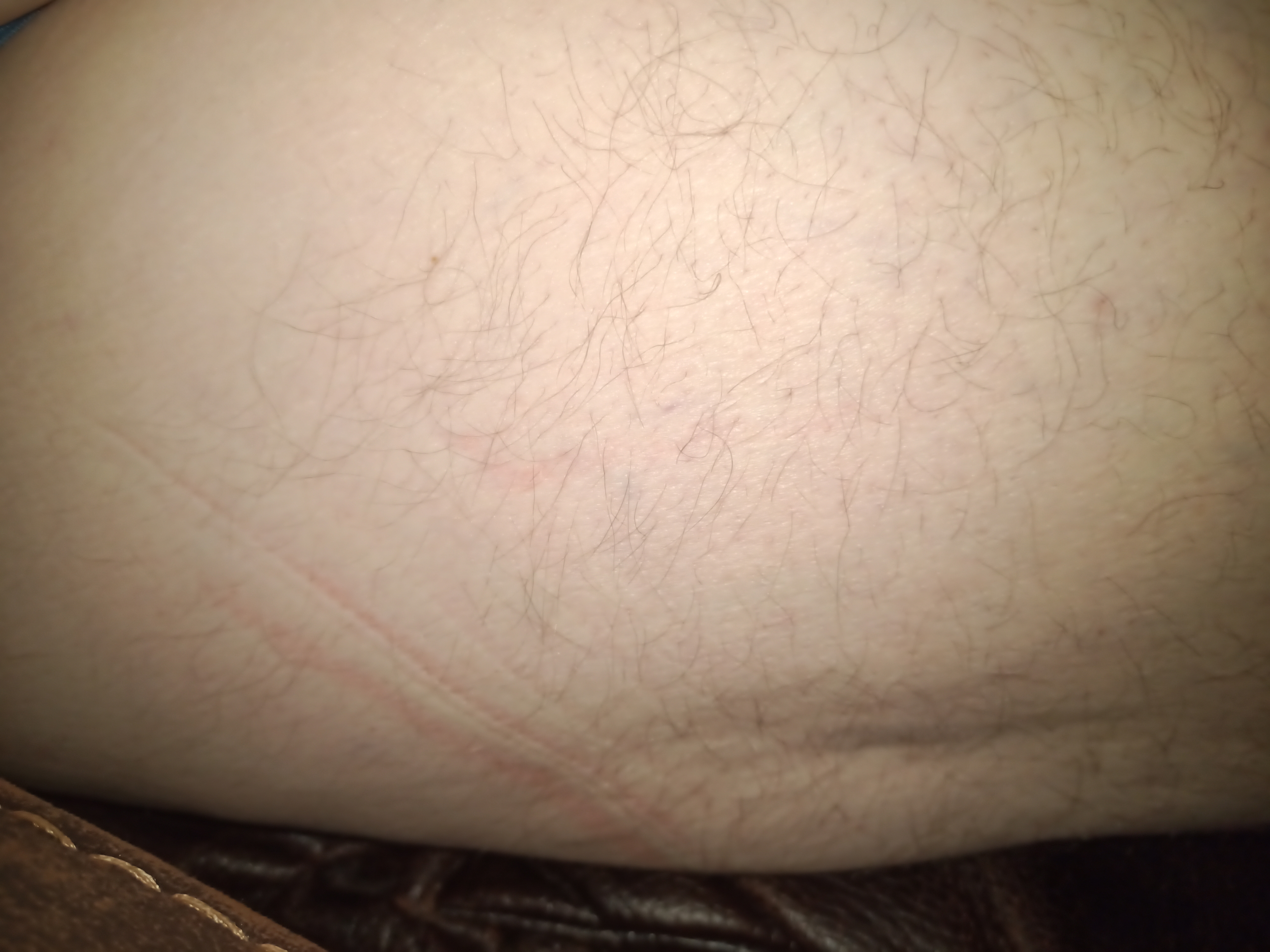 Cellulite