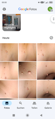 Fibrom, Stilwarzen am Hals