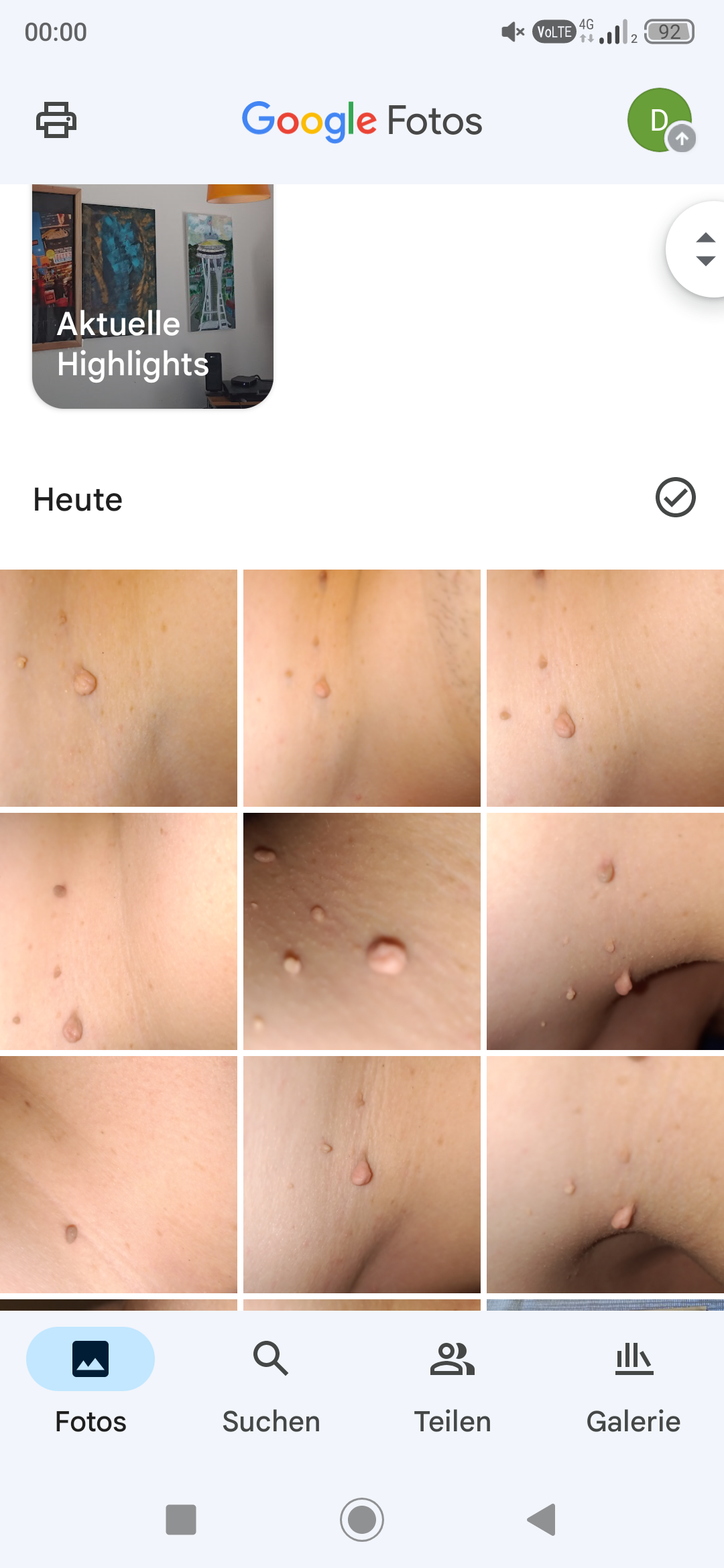 Fibrom, Stilwarzen am Hals