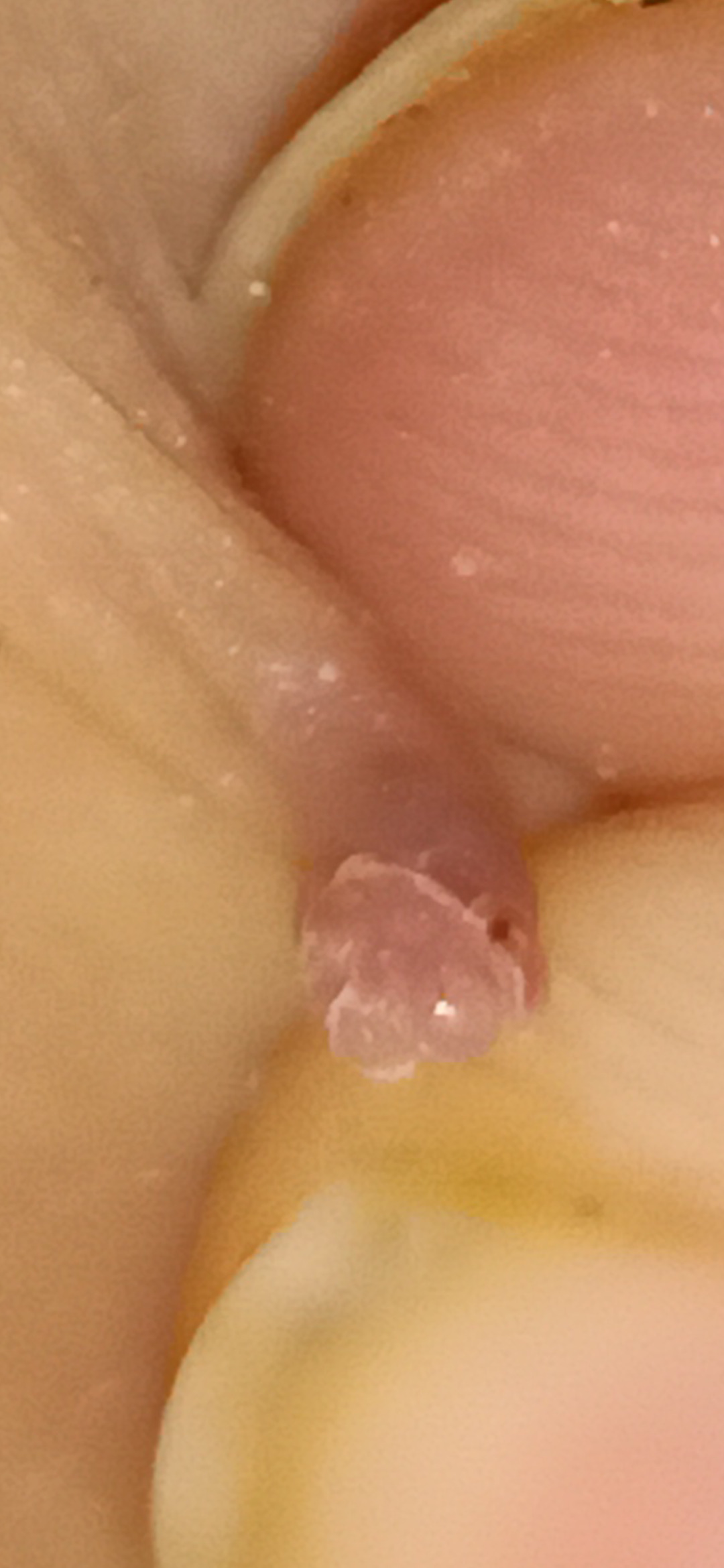 More Fibroms