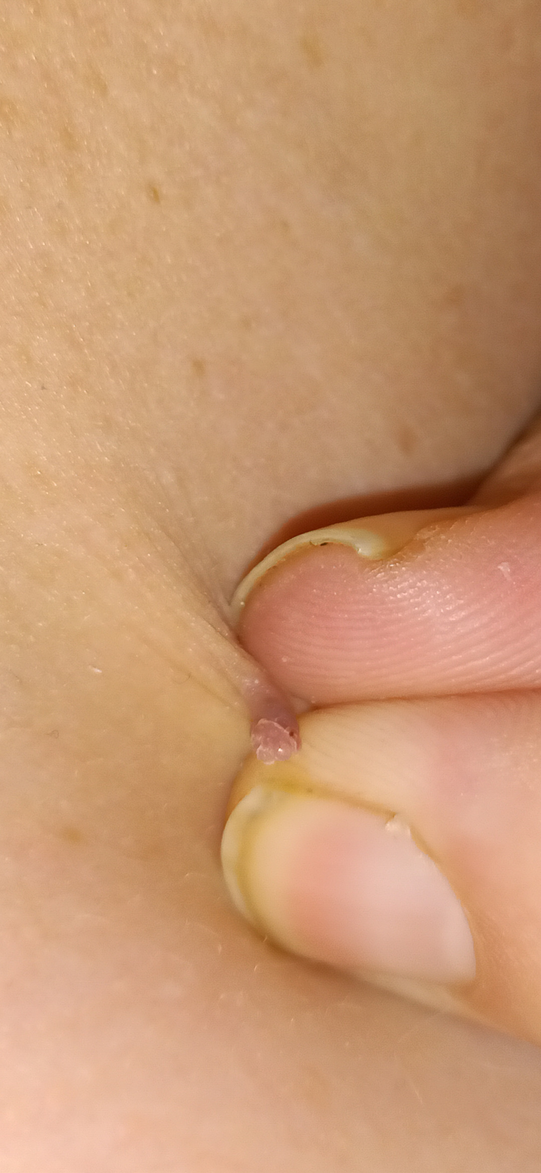 More Fibroms