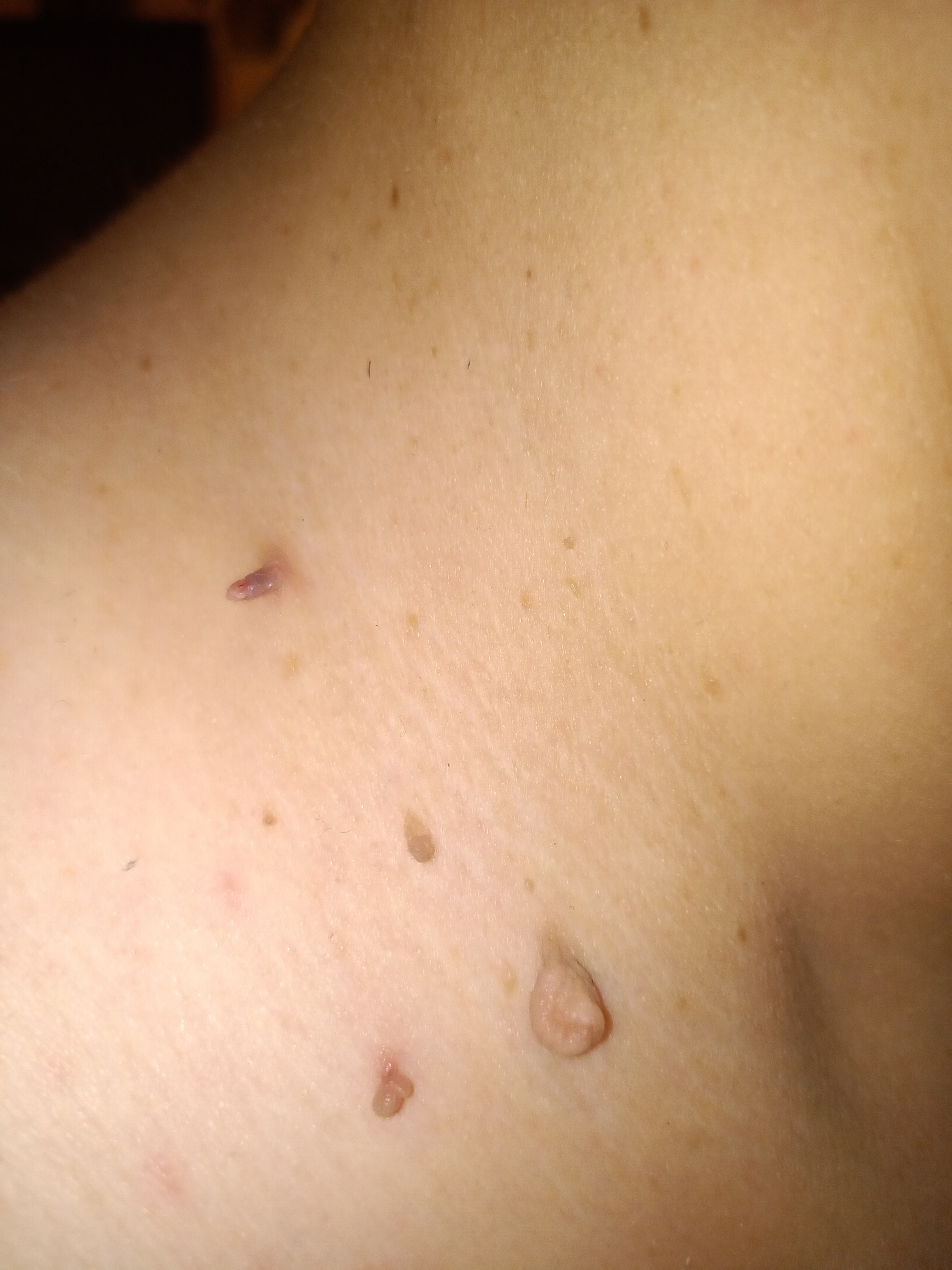 More Fibroms
