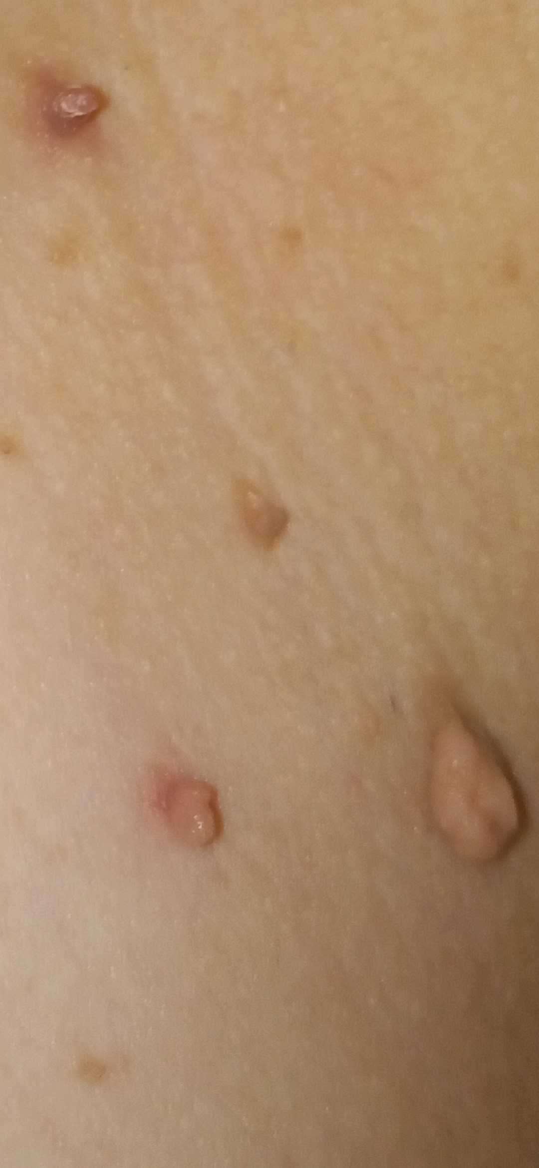 More Fibroms