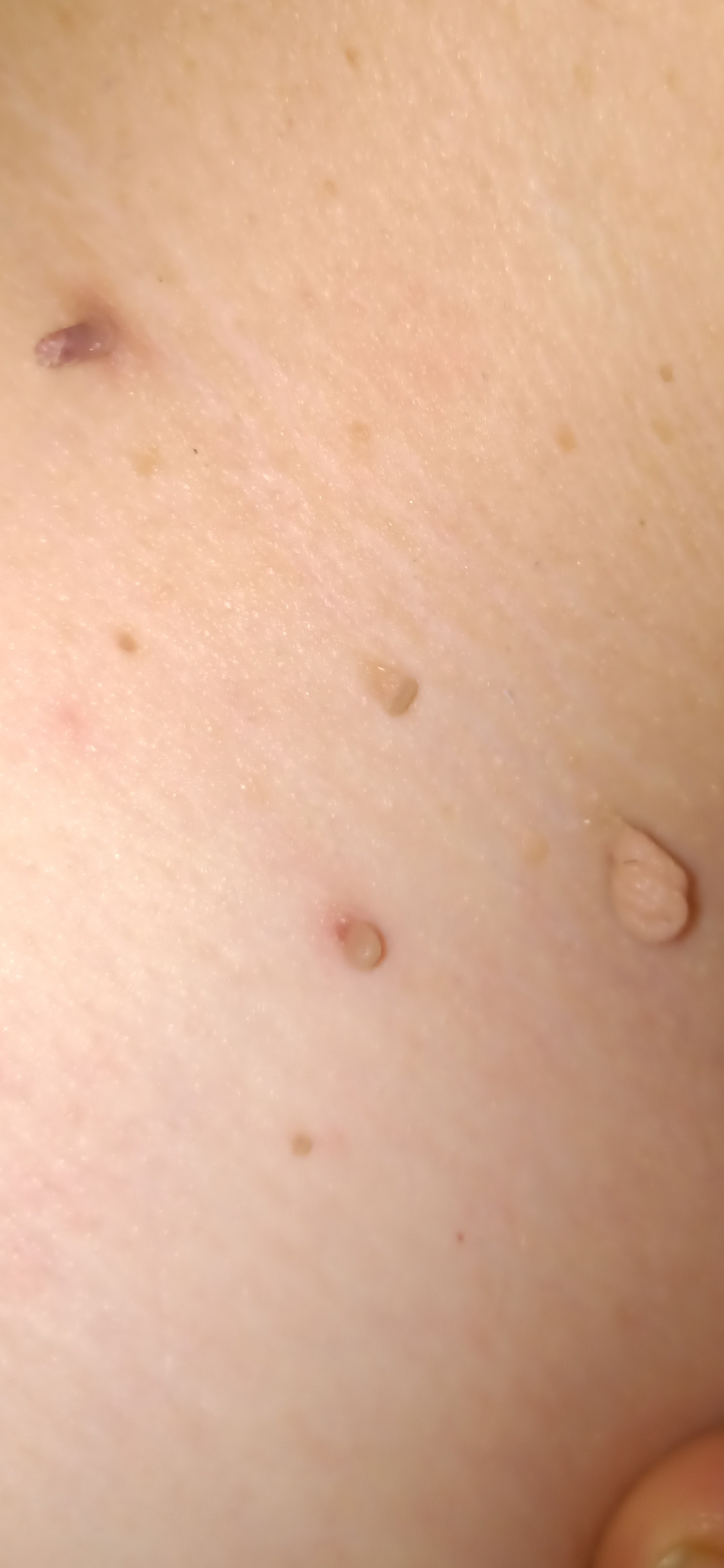 More Fibroms