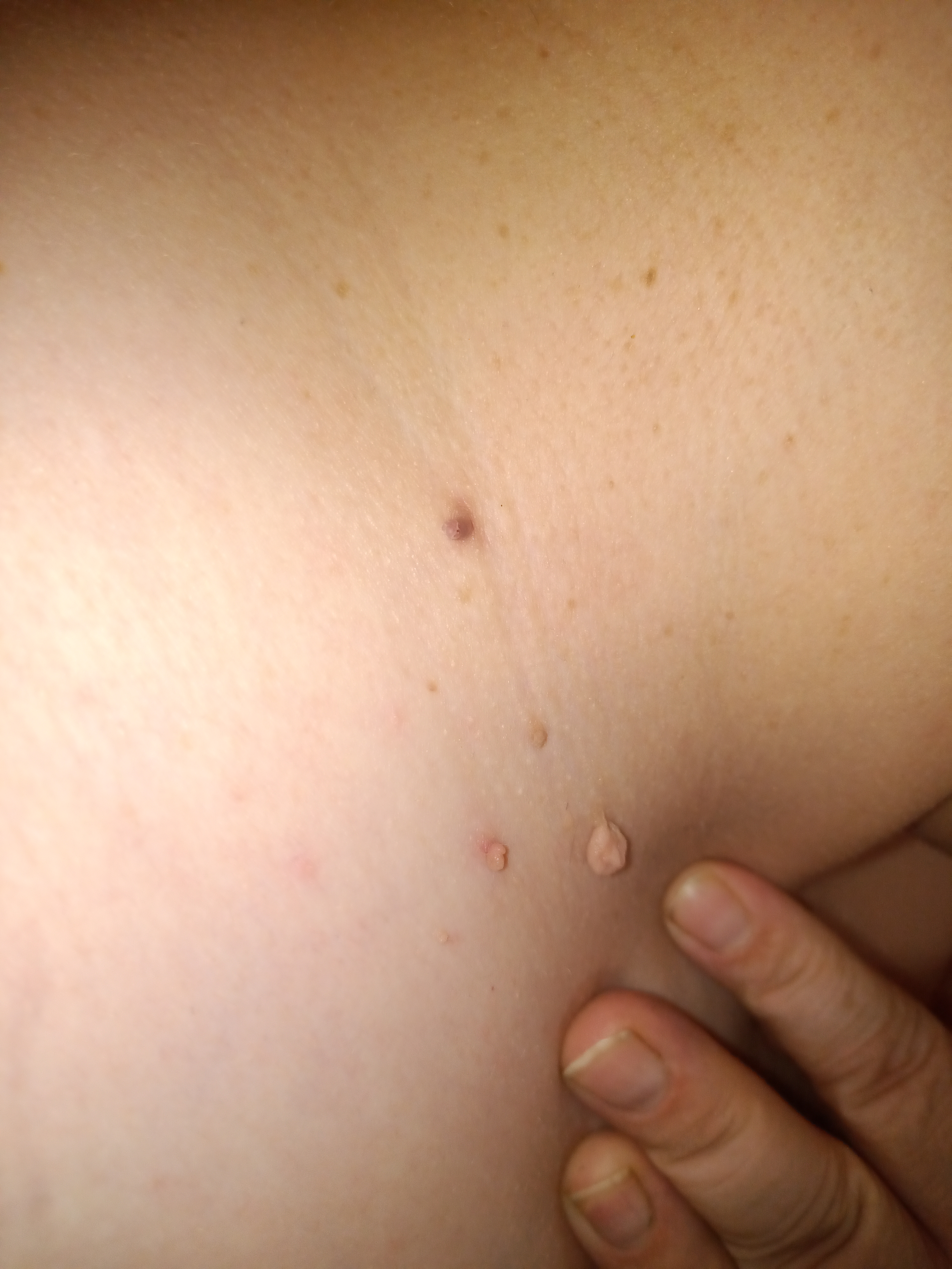 More Fibroms
