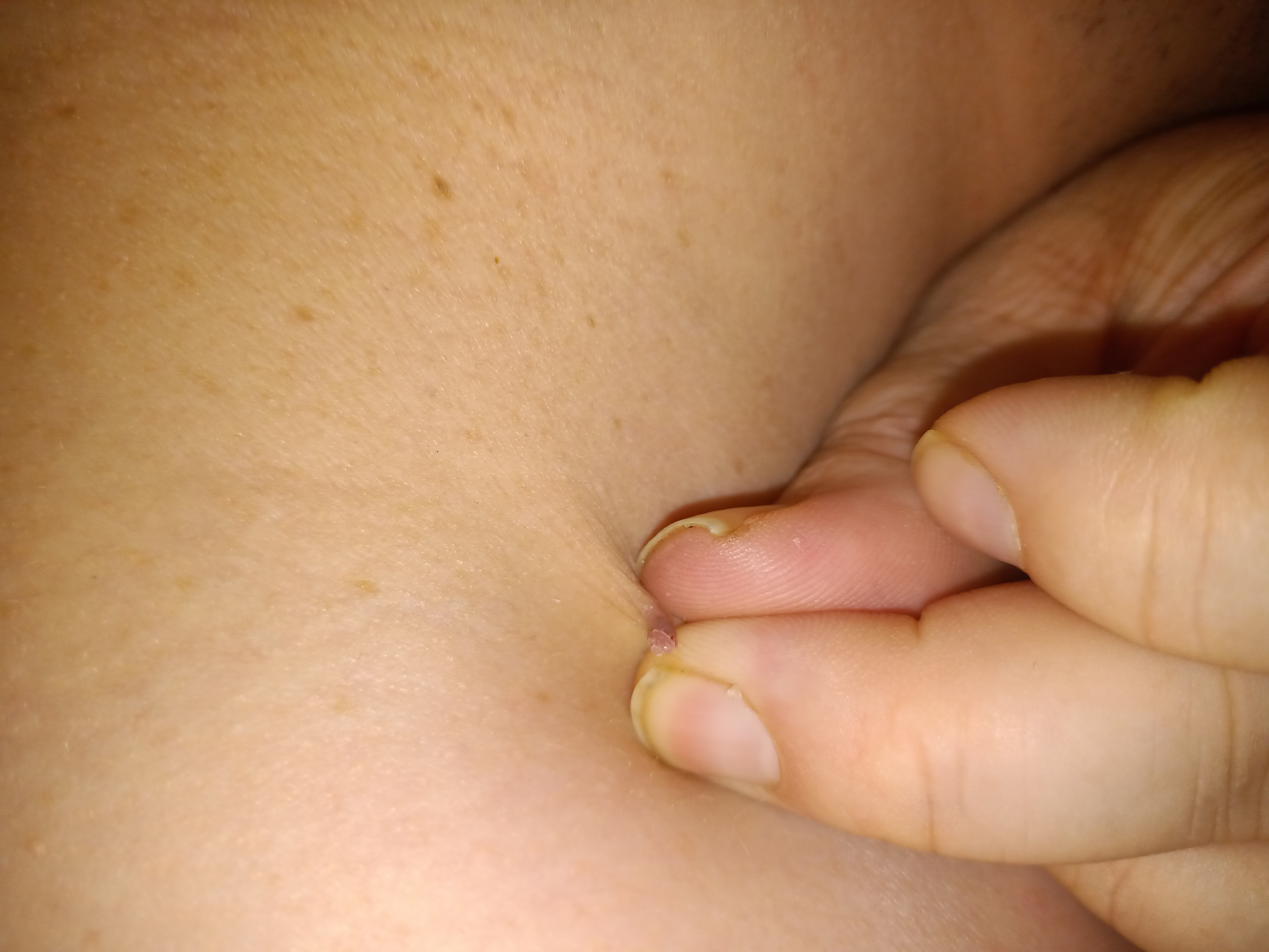 More Fibroms