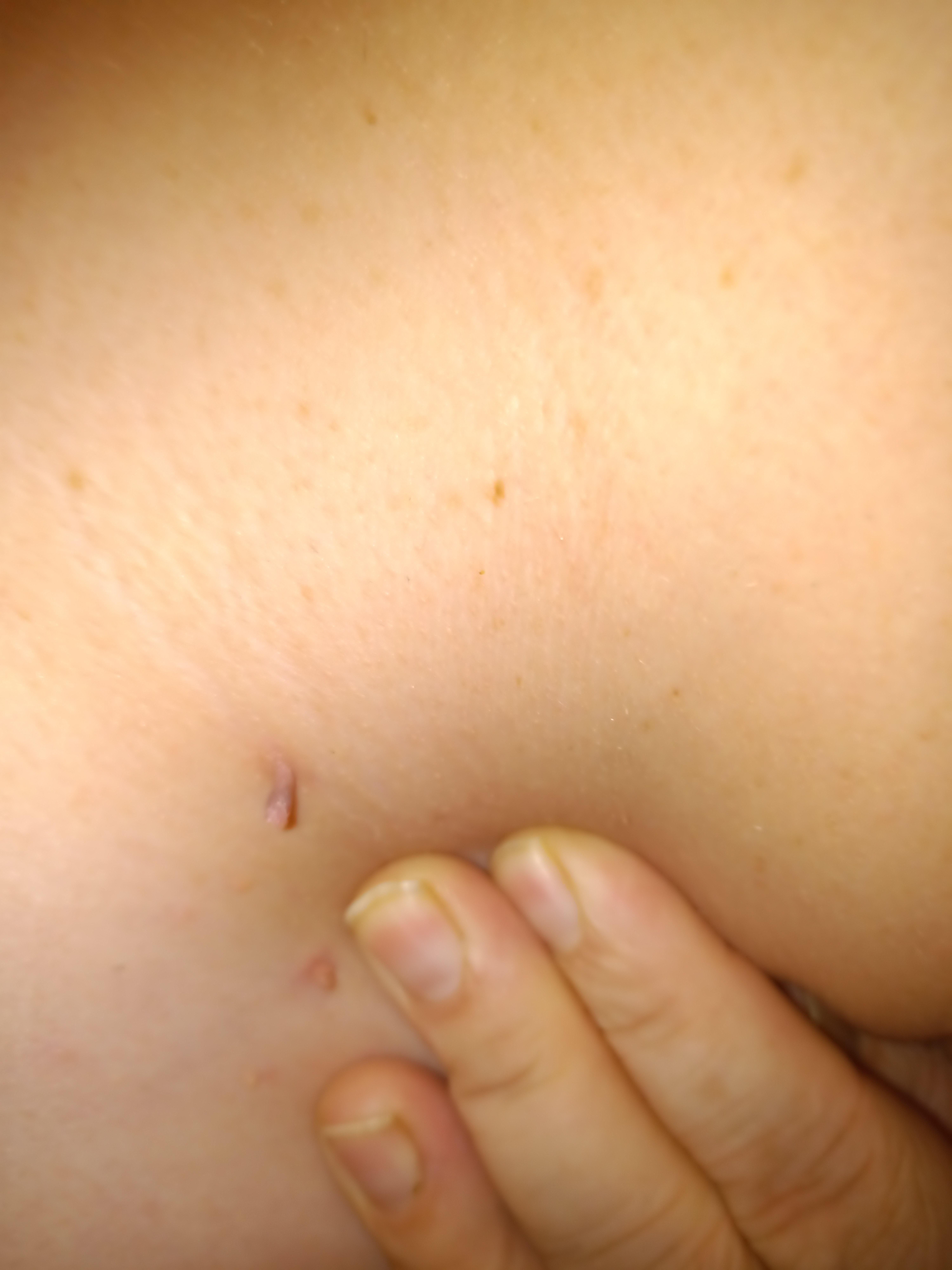 More Fibroms