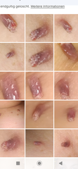 Fibrom, Stilwarzen am Hals