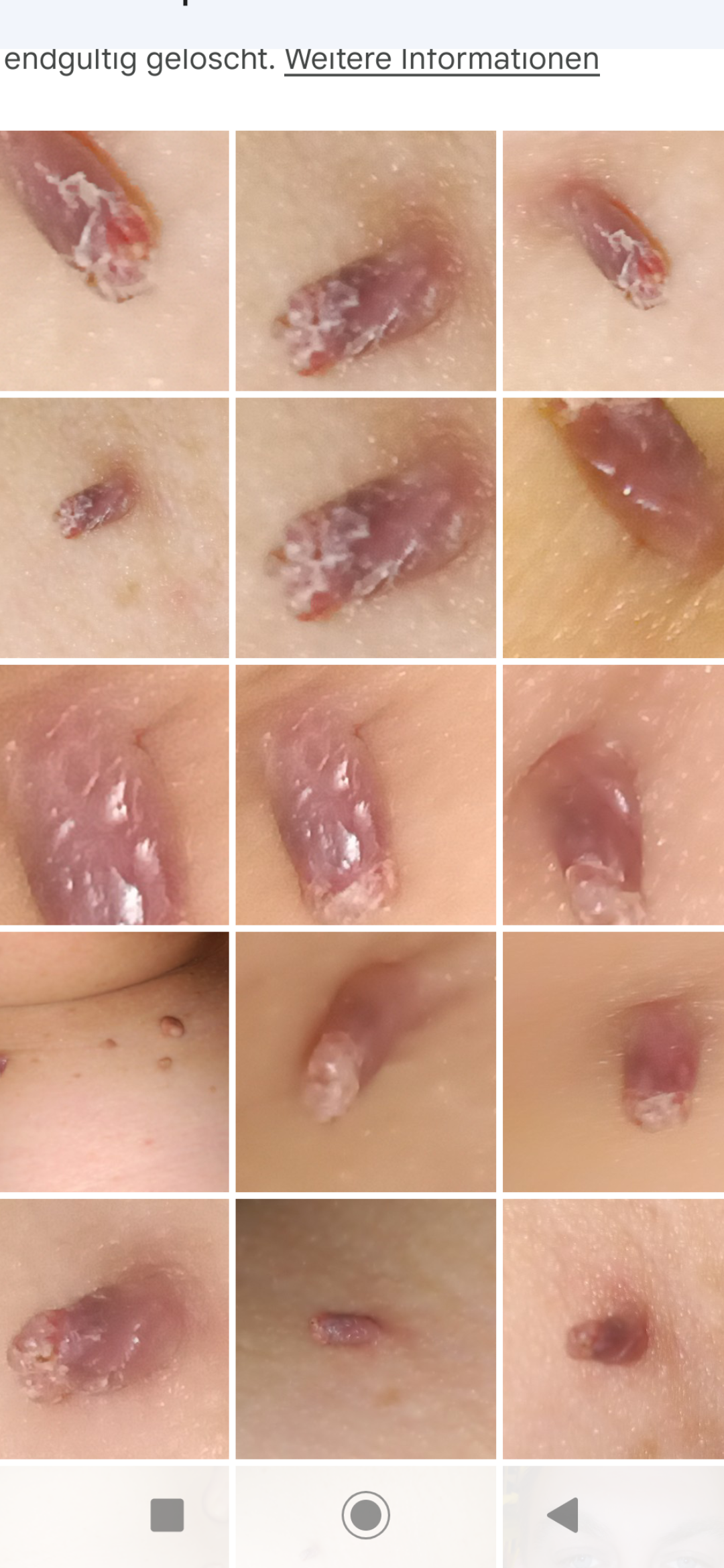 Fibrom, Stilwarzen am Hals