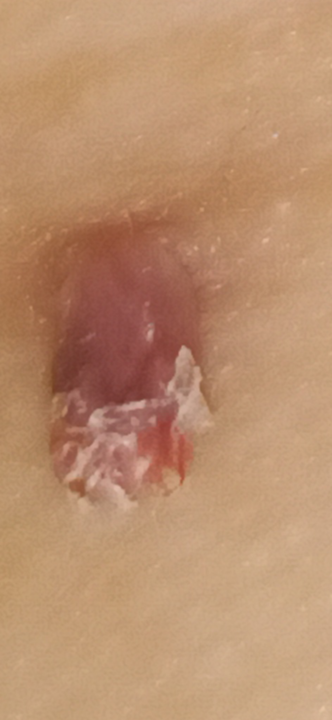 Fibrom, Stilwarzen am Hals
