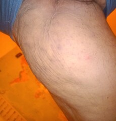 Oedem Cellulite