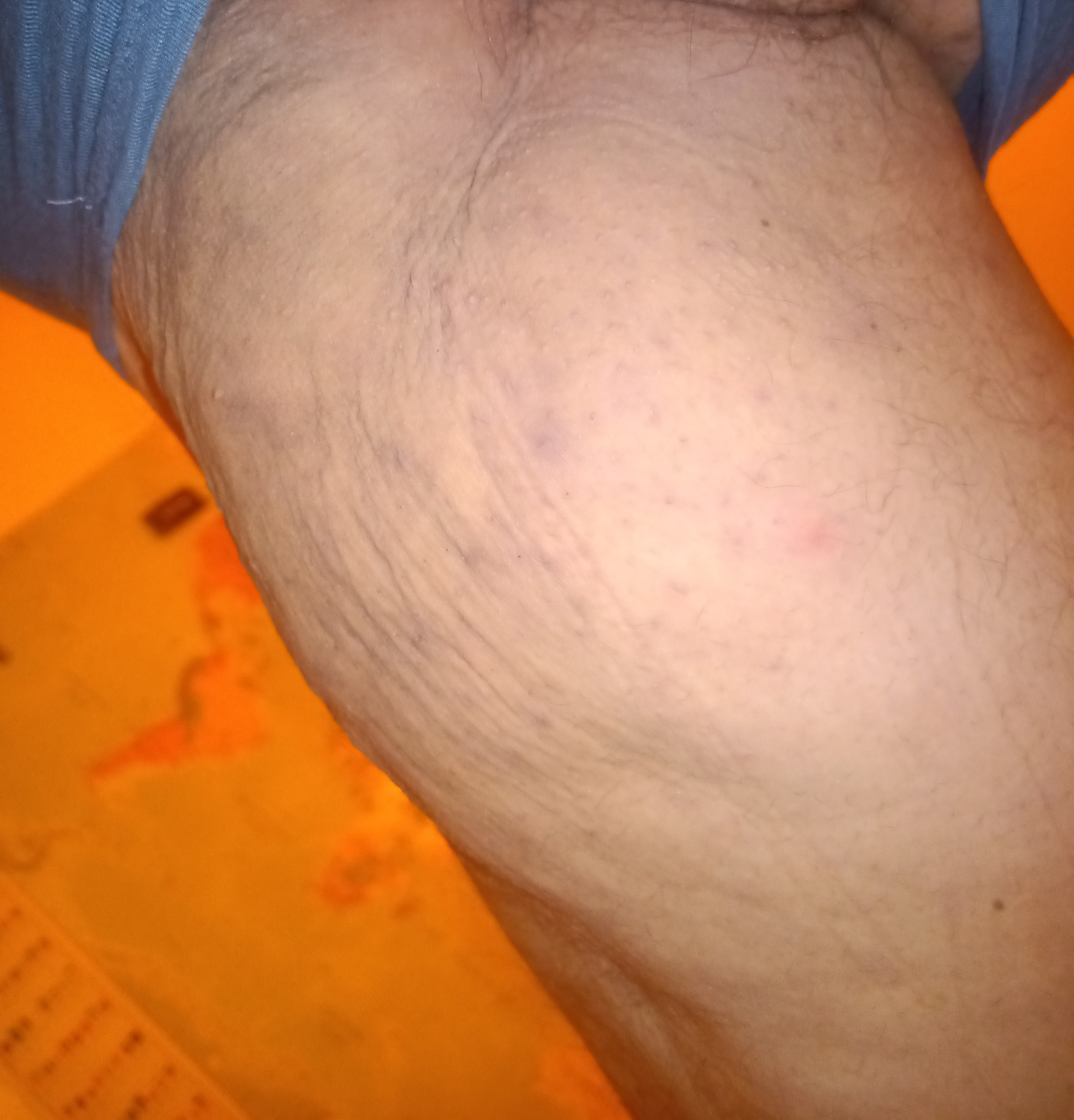 Oedem Cellulite