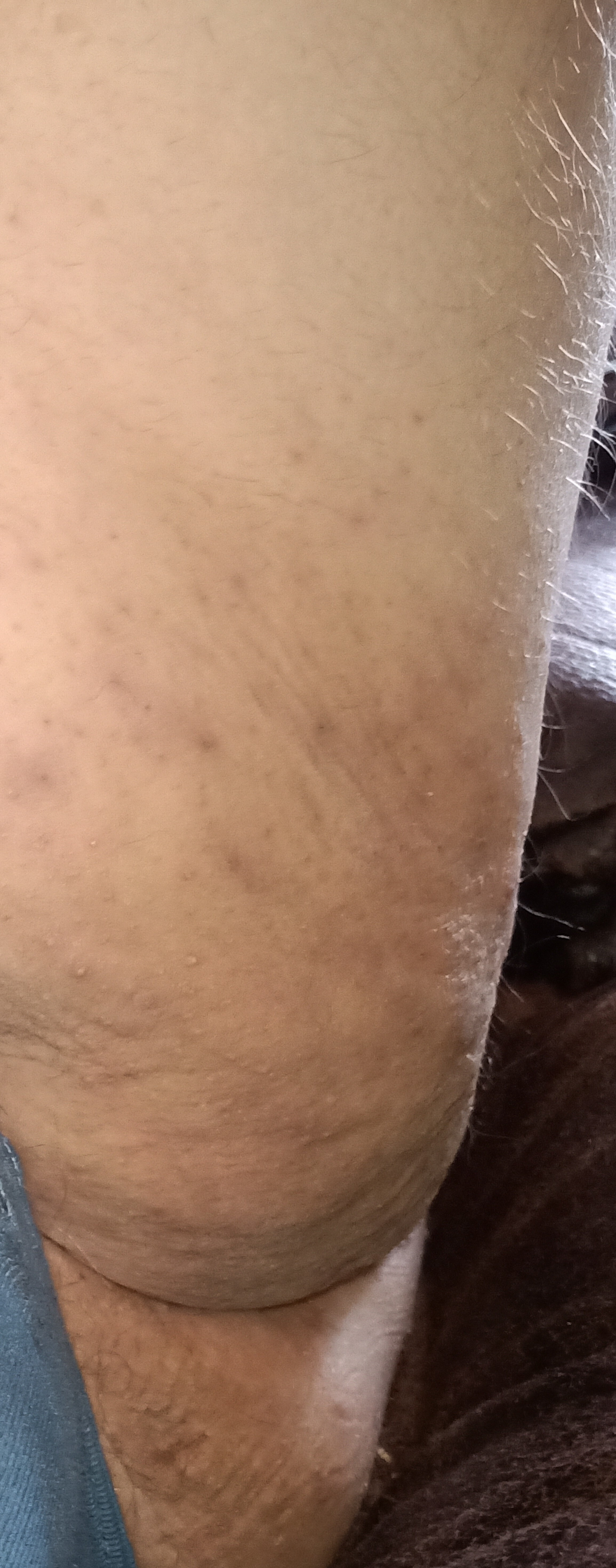 Oedem Cellulite