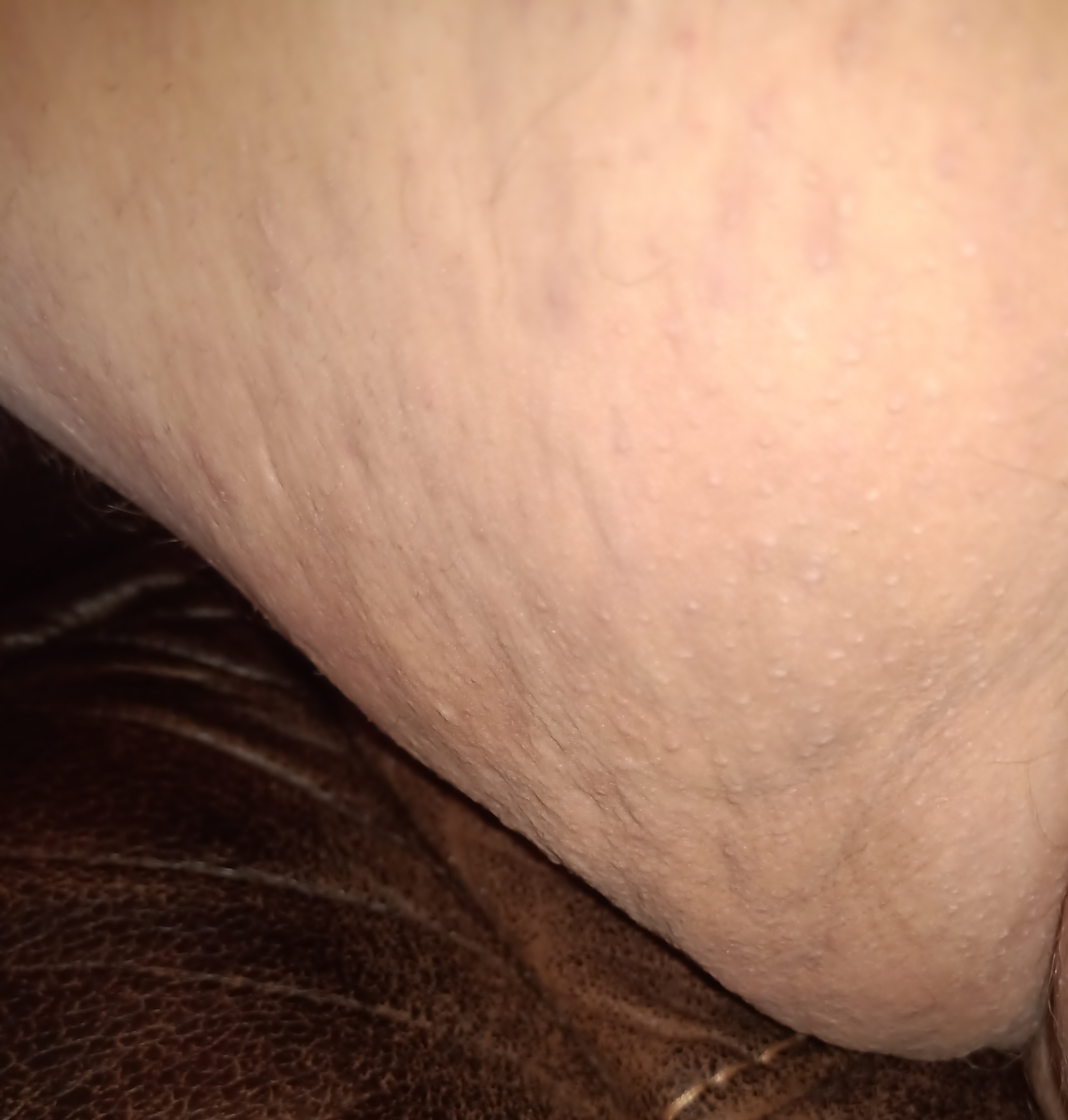 Oedem Cellulite