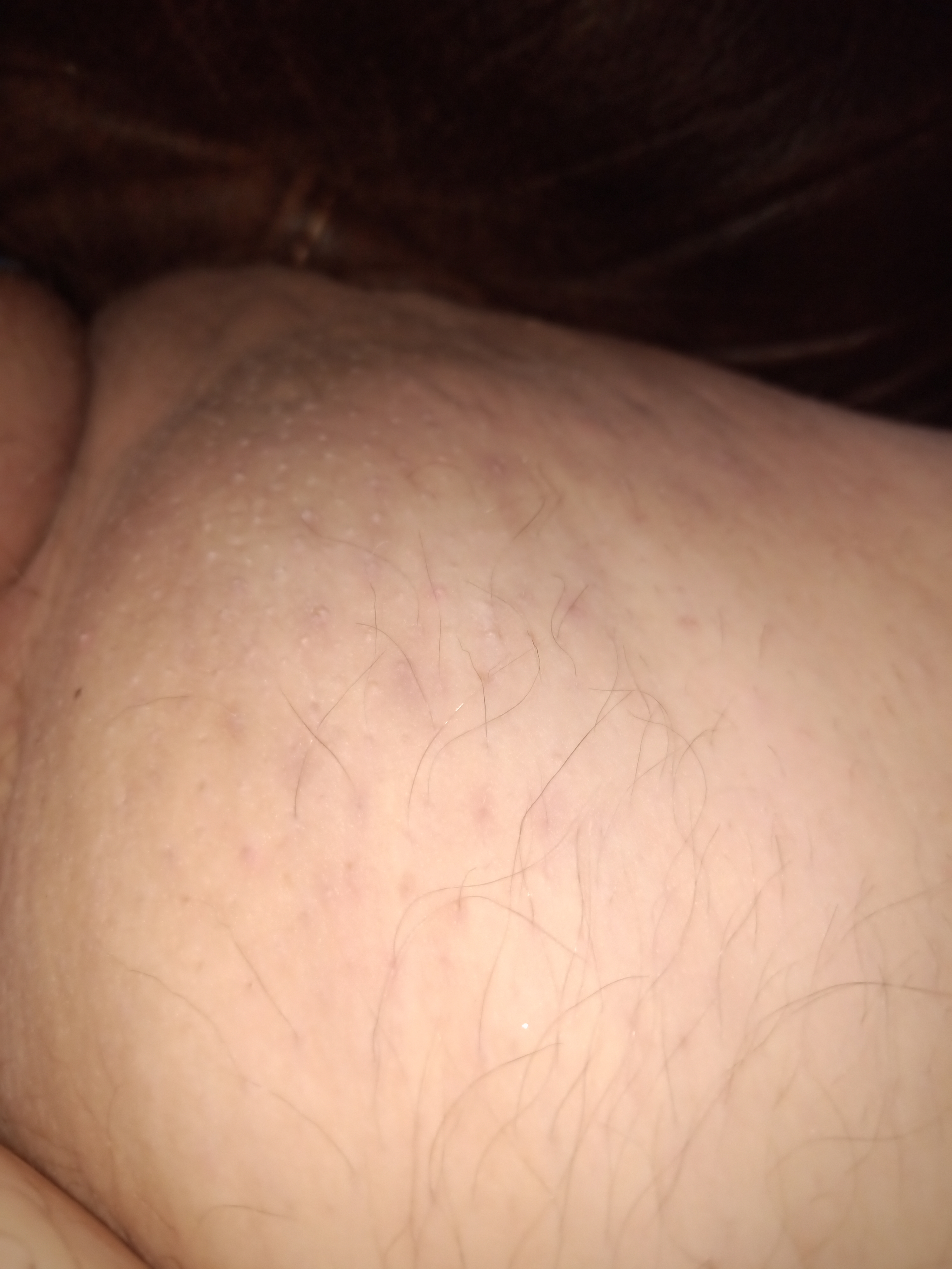 Oedem Cellulite