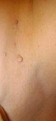 Fibrom, Stilwarzen am Hals