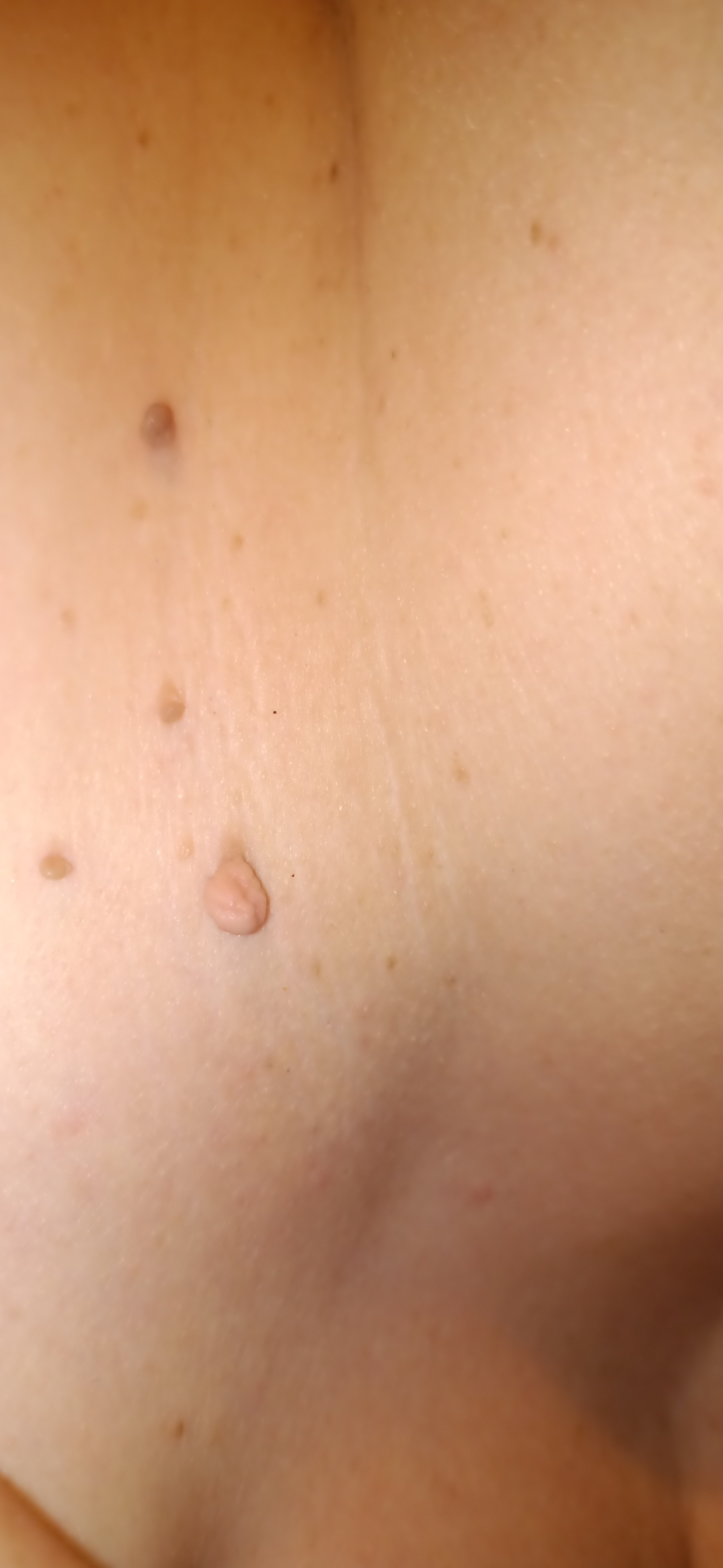 Fibrom, Stilwarzen am Hals