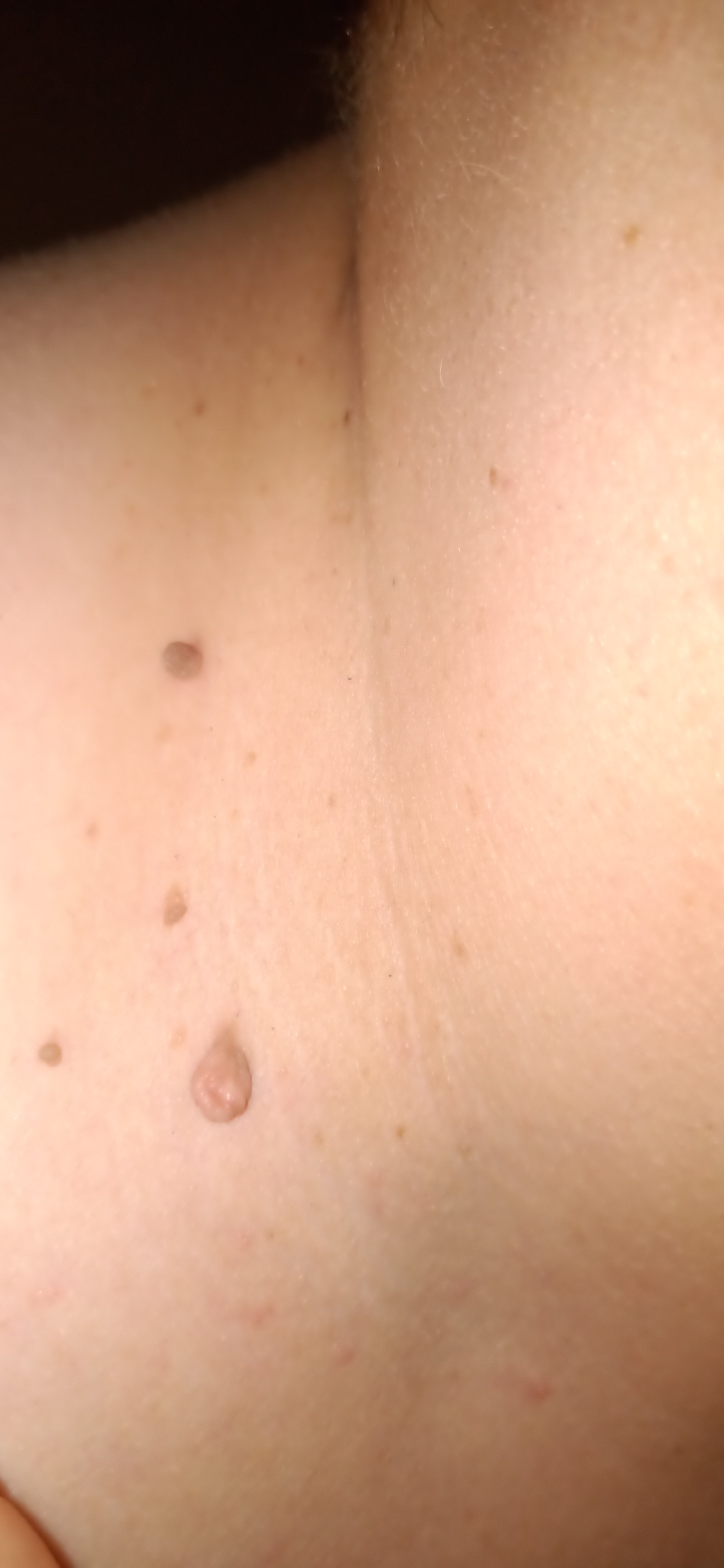 Fibrom, Stilwarzen am Hals