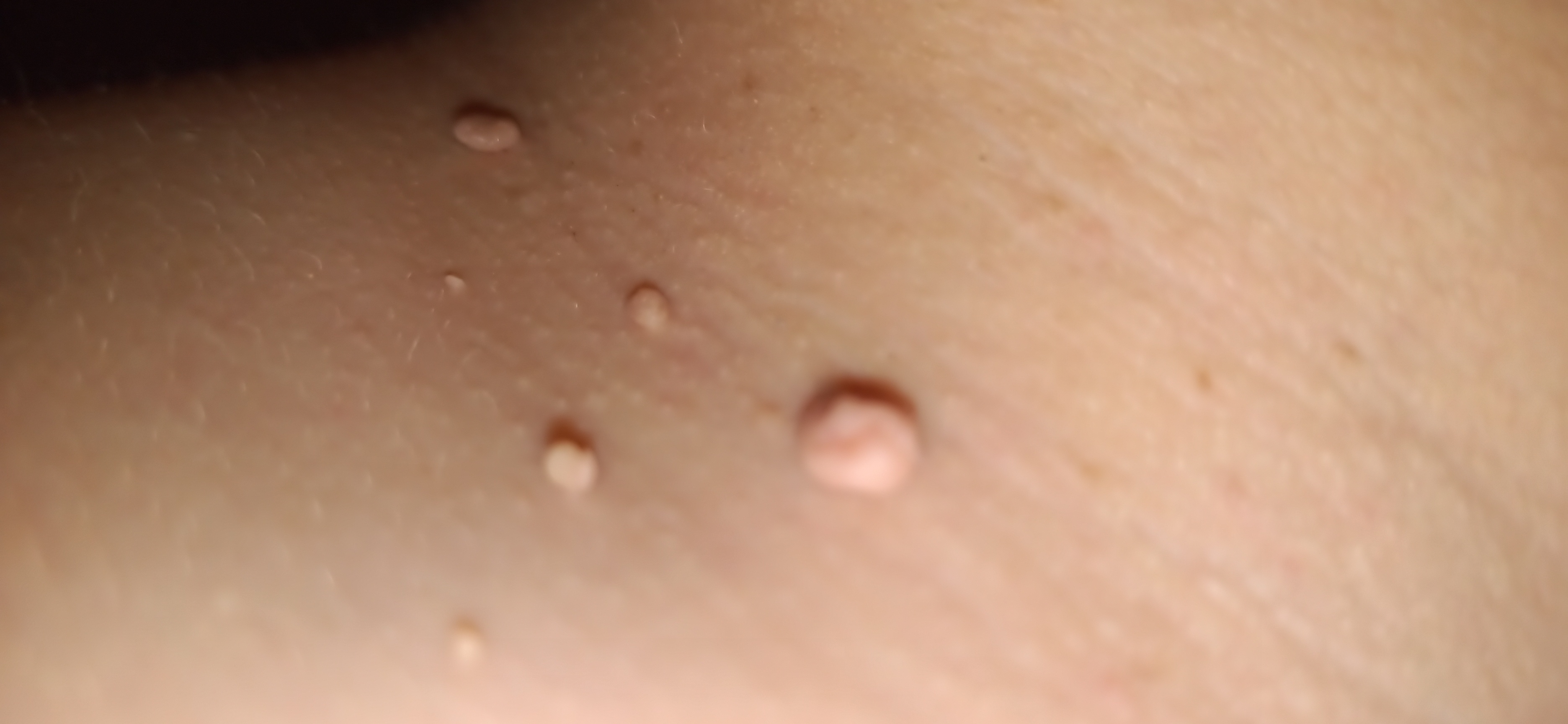Fibrom, Stilwarzen am Hals