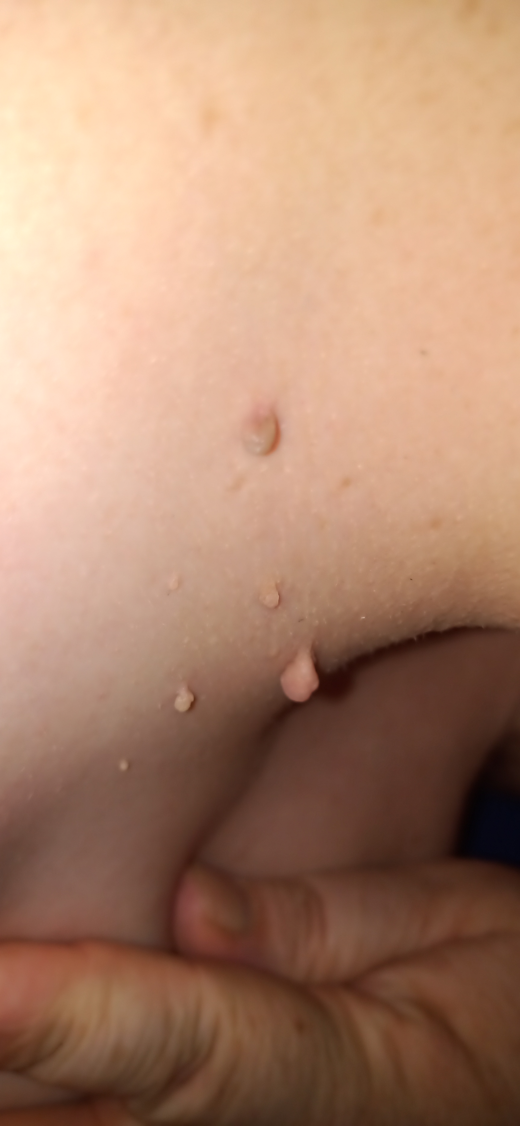 Fibrom, Stilwarzen am Hals
