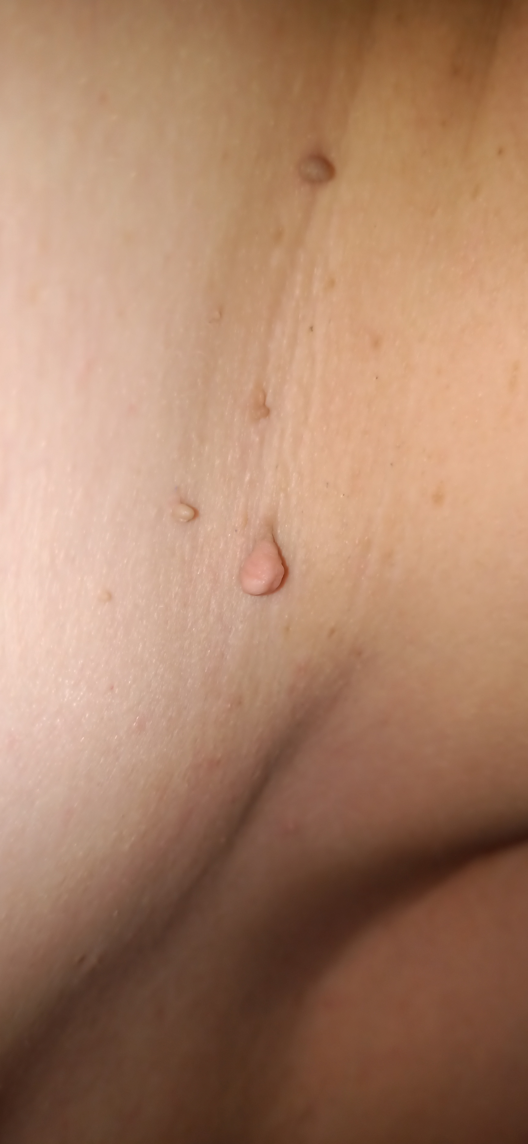 Fibrom, Stilwarzen am Hals