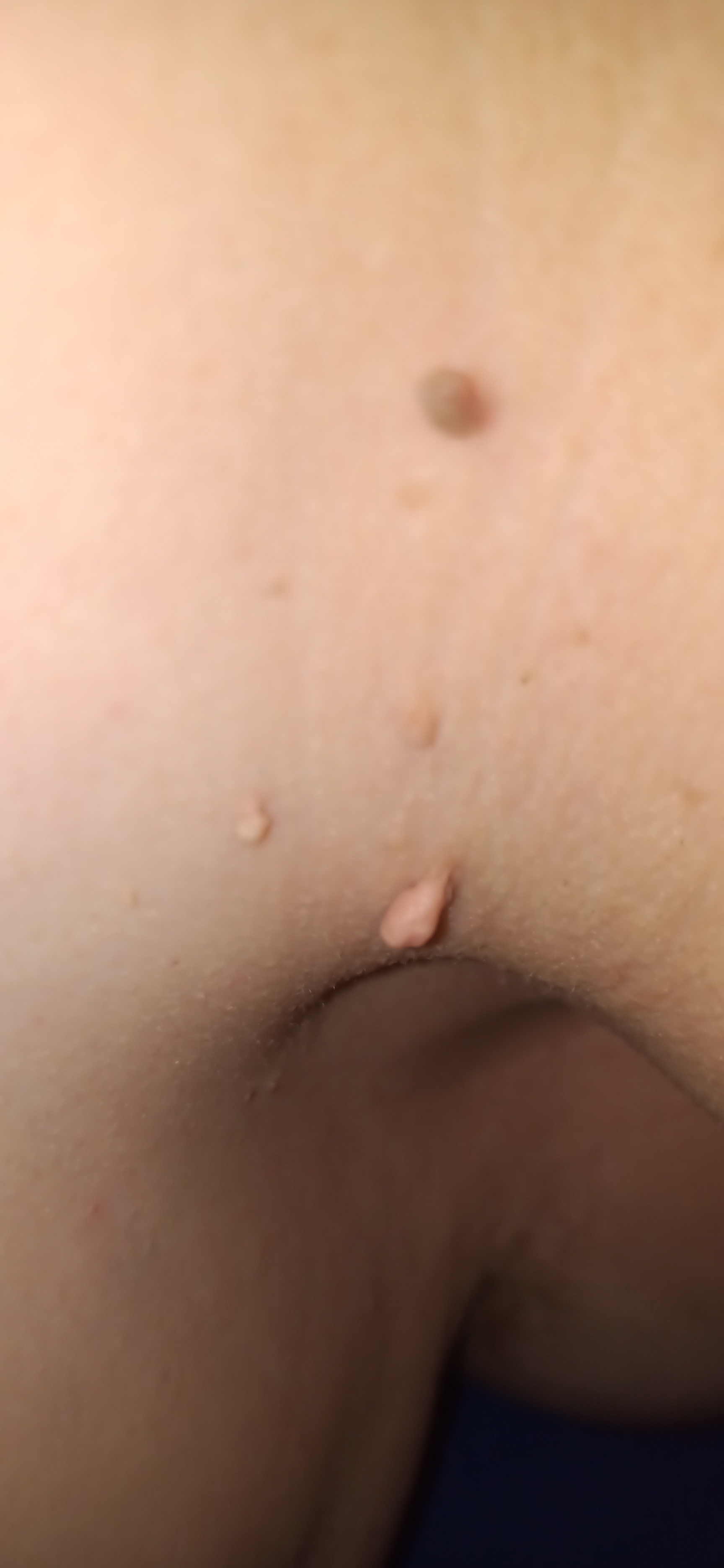 Fibrom, Stilwarzen am Hals