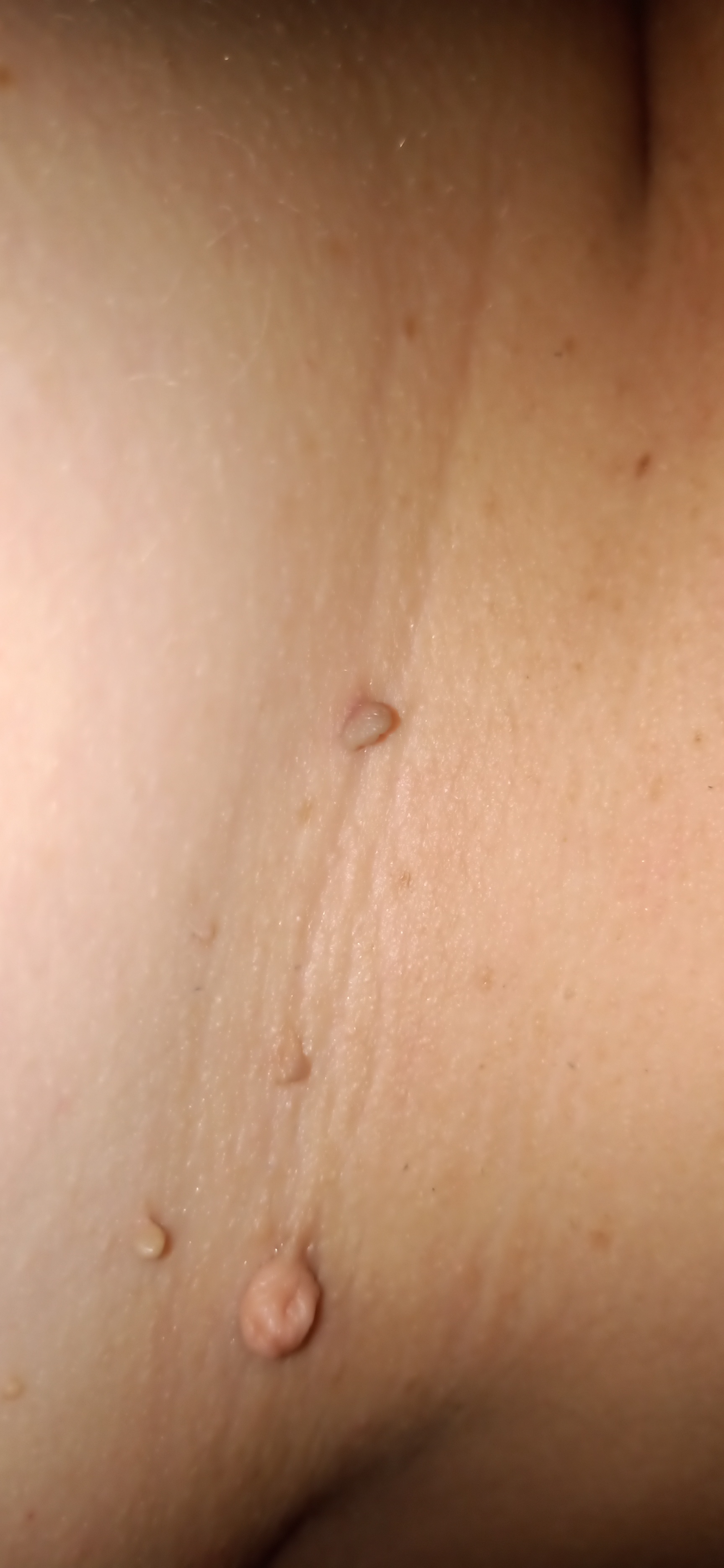 Fibrom, Stilwarzen am Hals
