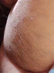Cellulite