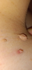 Fibroms extrem
