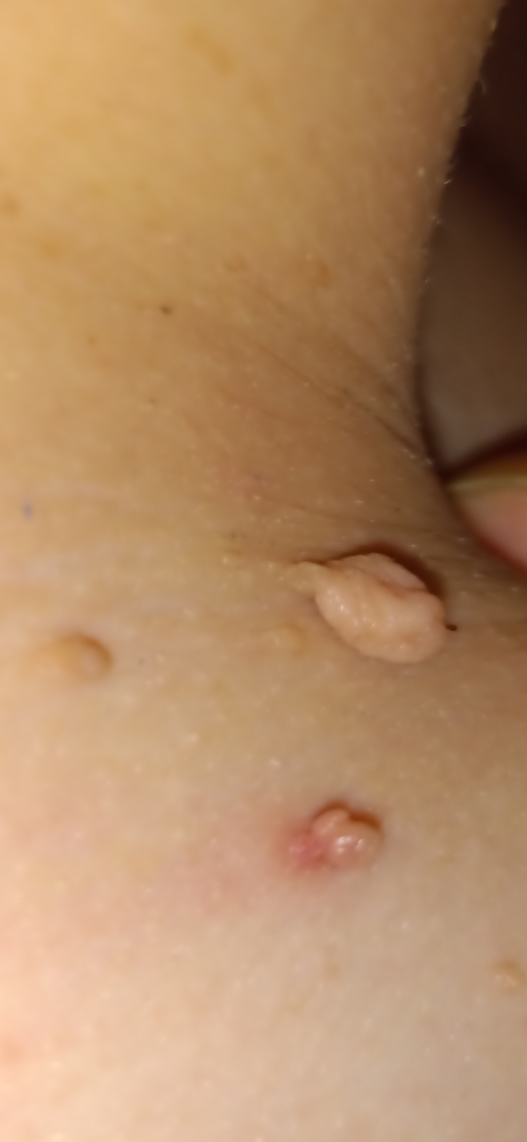 Fibroms extrem