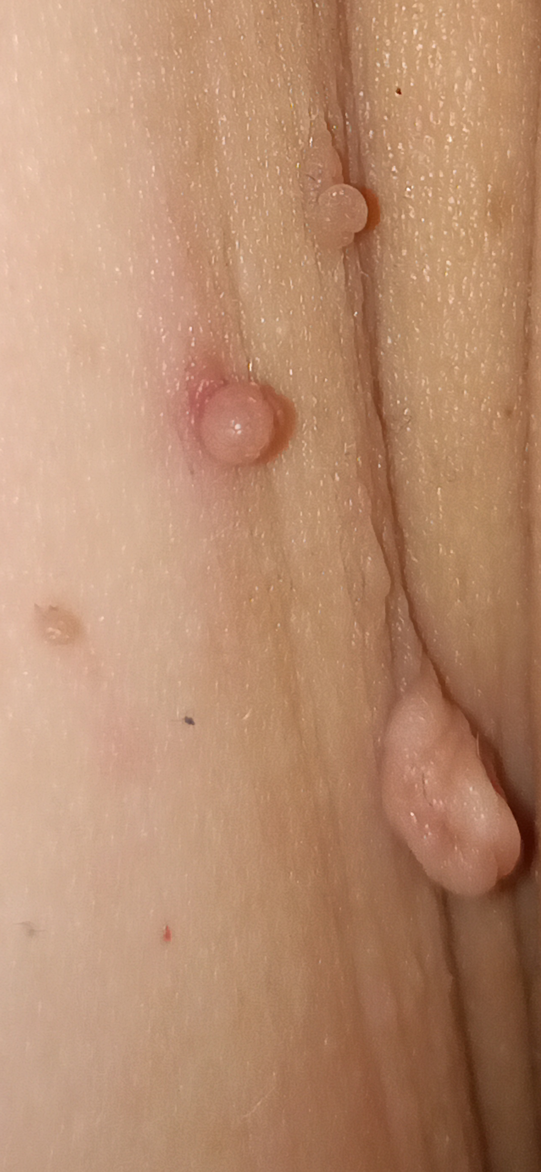 Fibroms extrem