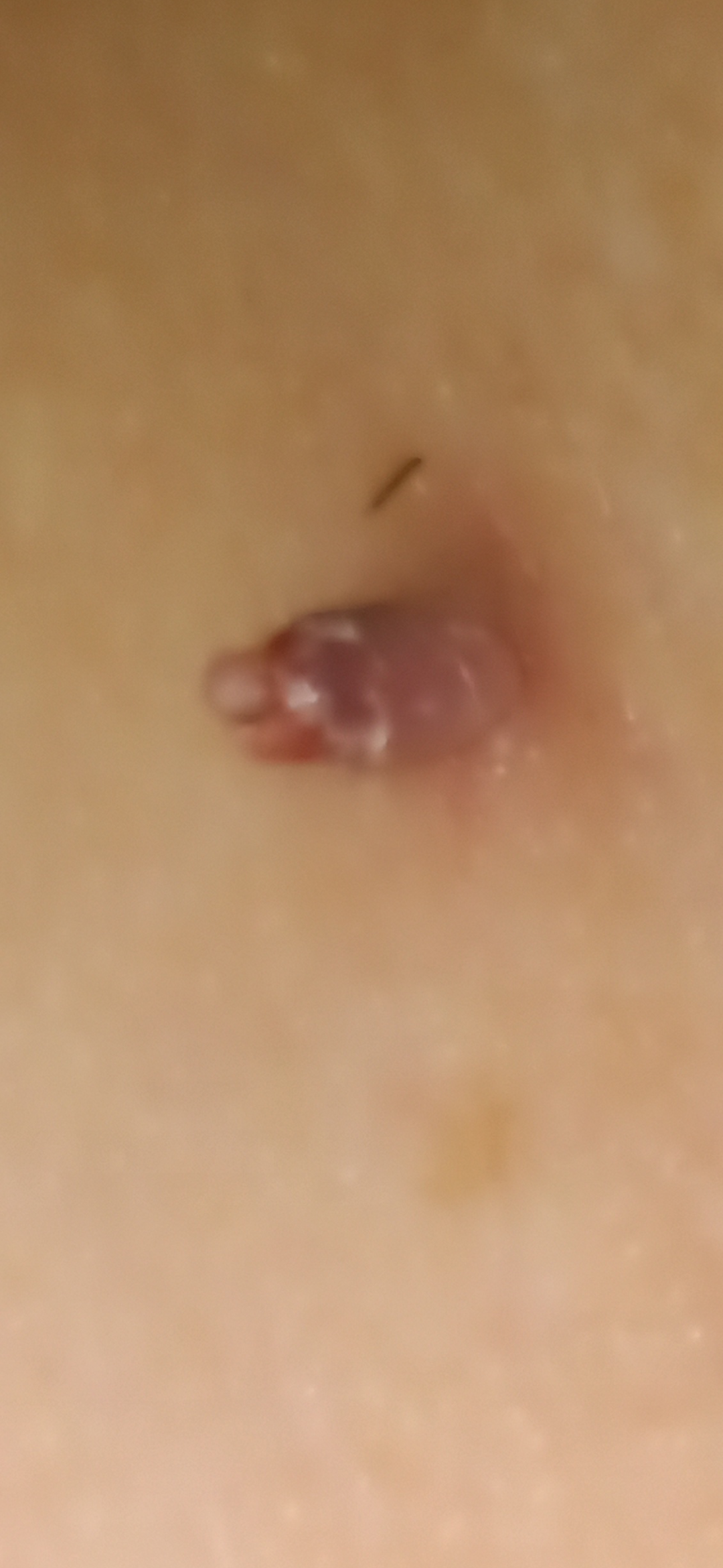 Fibroms extrem