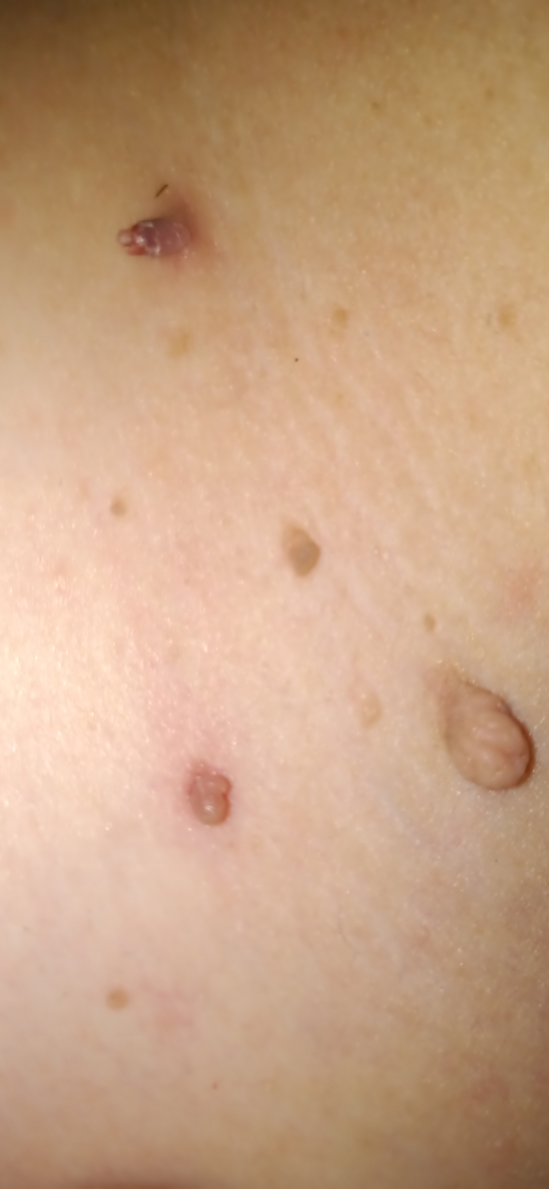 Fibroms extrem