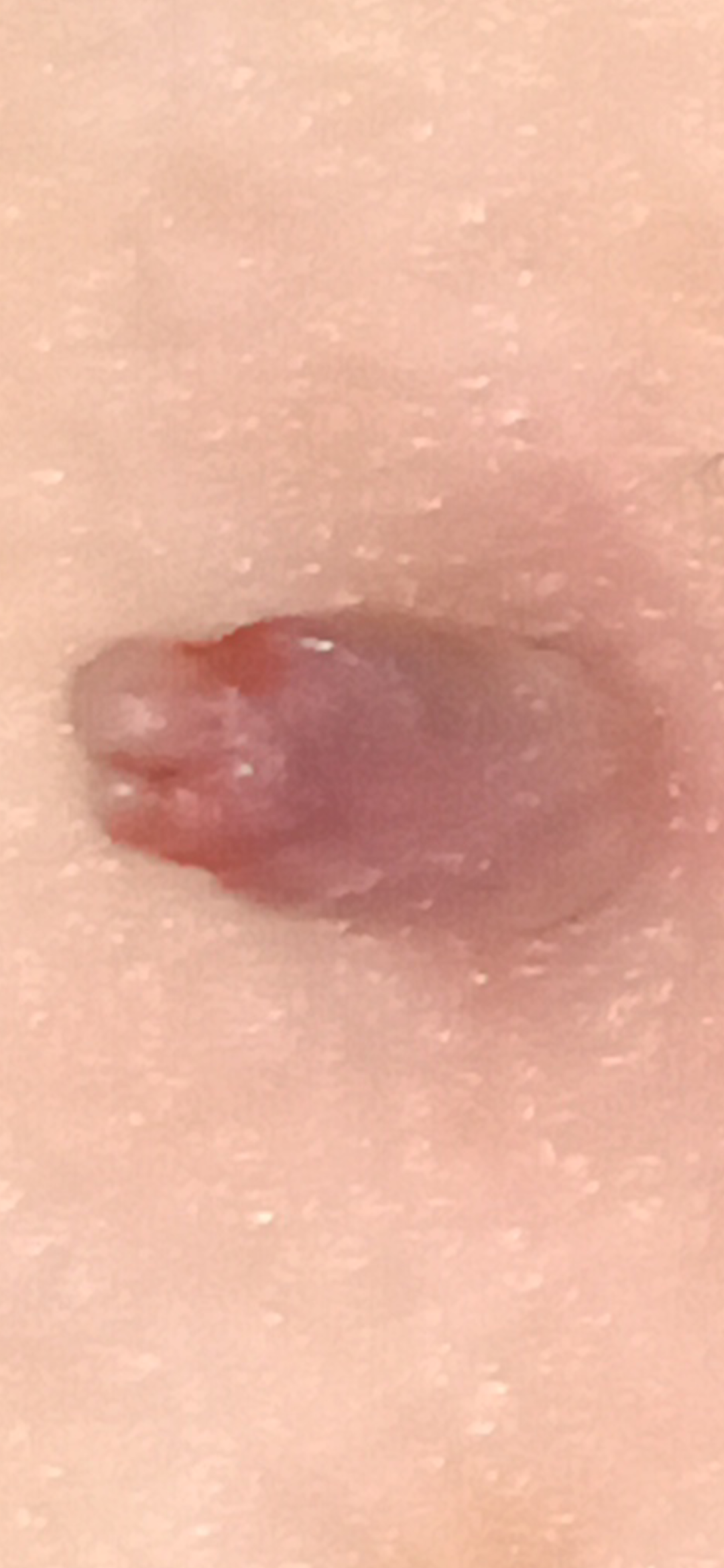 Fibroms extrem